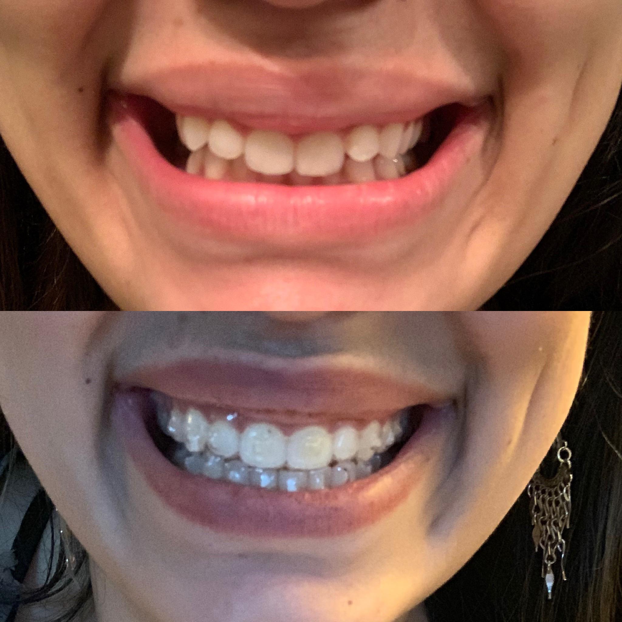 Tray 21/26 before refinements! Always used to cover my gummy smile with