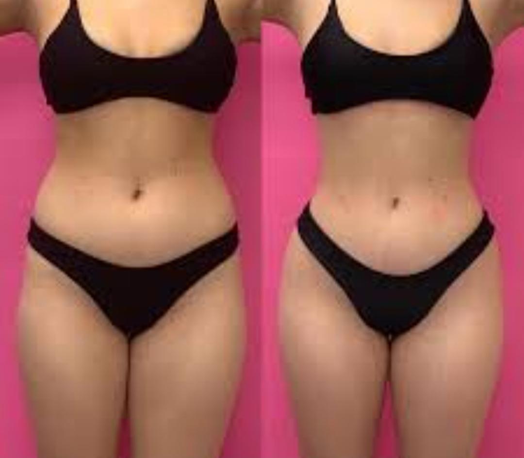 I am currently saving up for a skinny BBL (yet to have a consultation