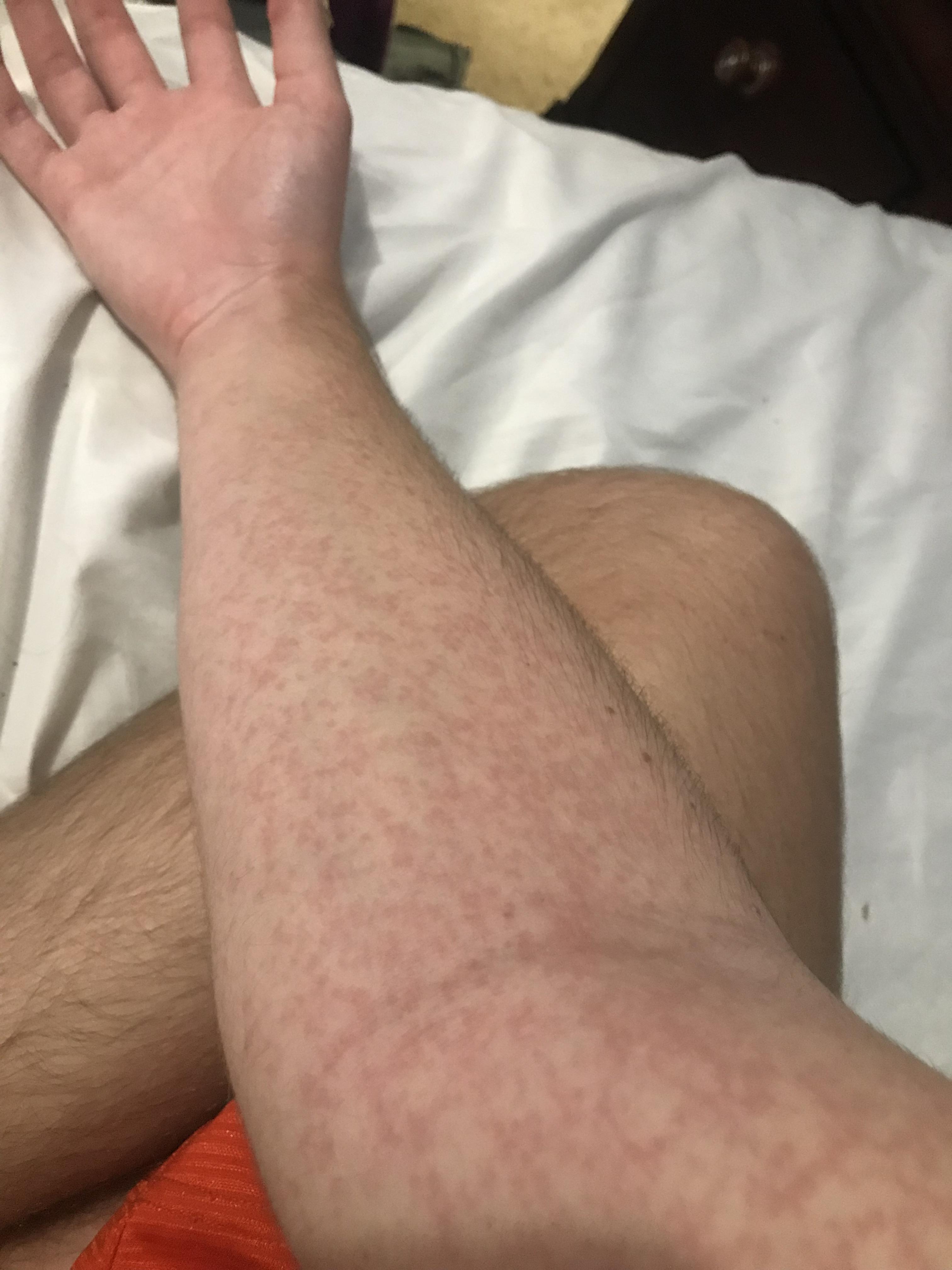 Rash that forms within minutes and disappears within an hour usually
