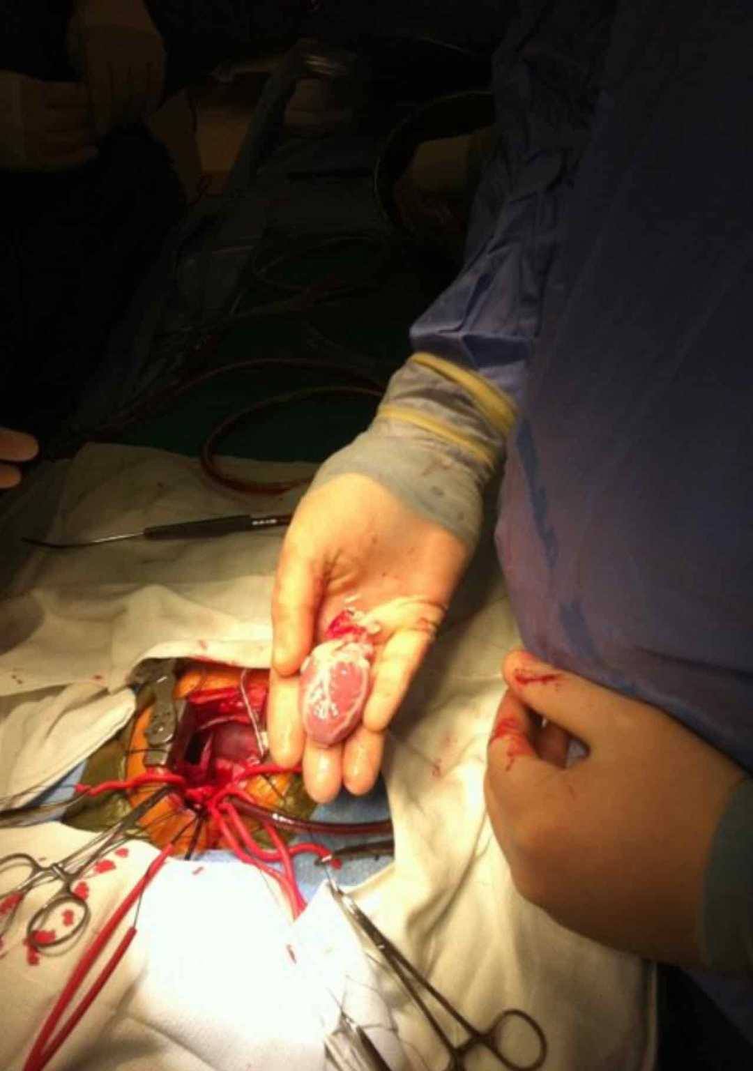 A rare look into a pediatric heart transplant procedure. The recipient