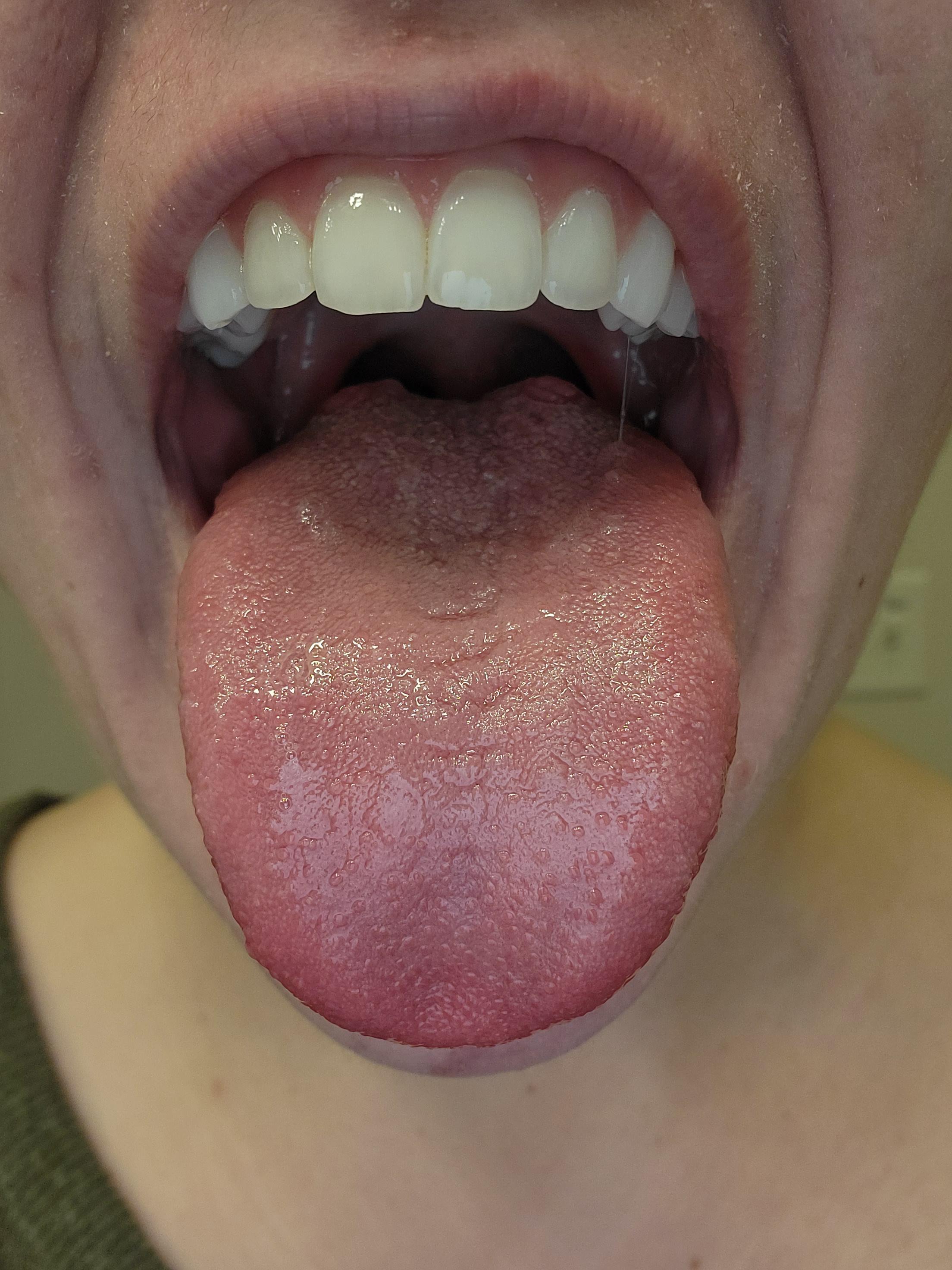 Need a reference for a what a (mostly) thrushfree tongue looks like
