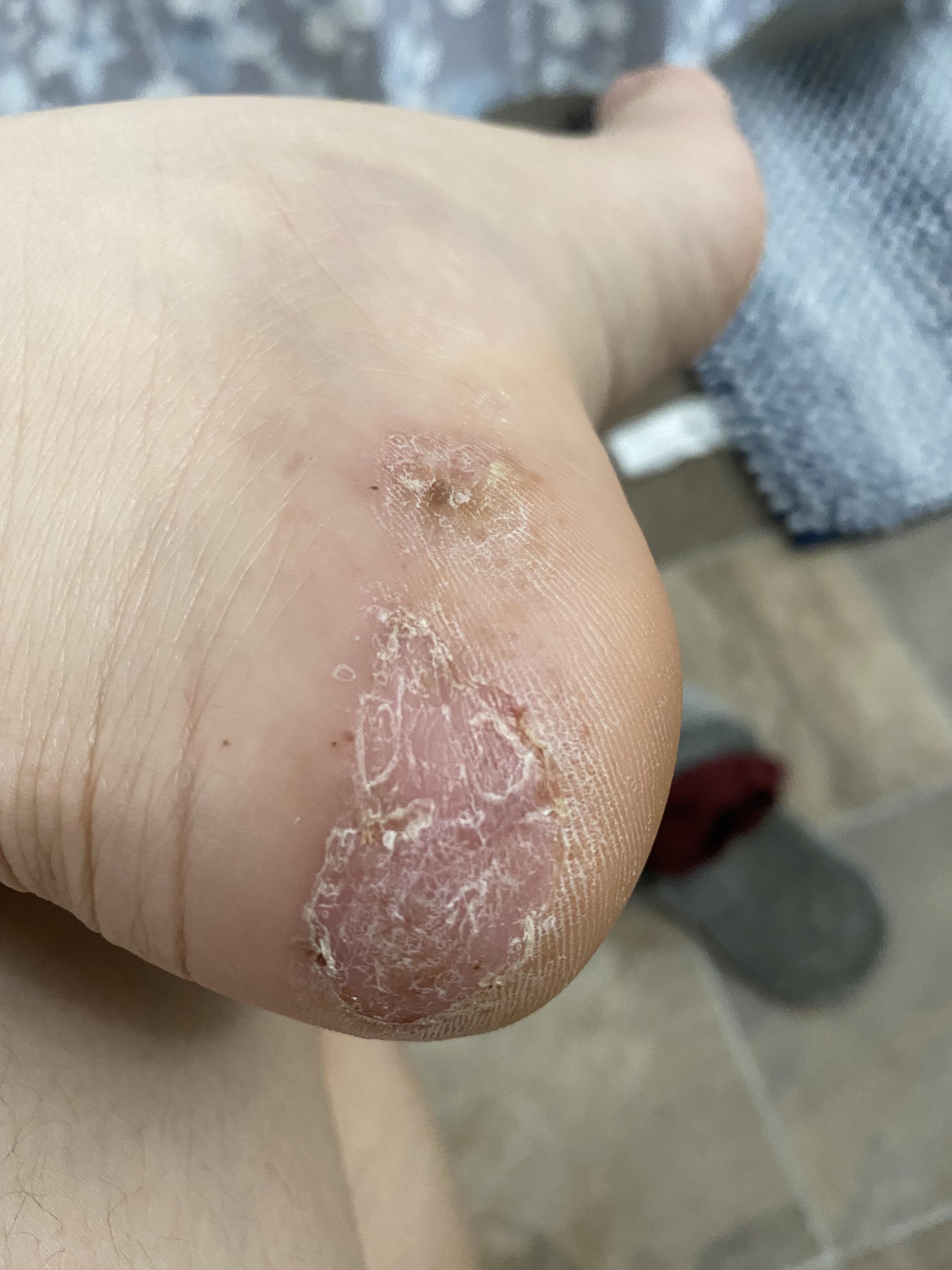 Does this look normal for a dyshidrotic eczema? I’ve been putting