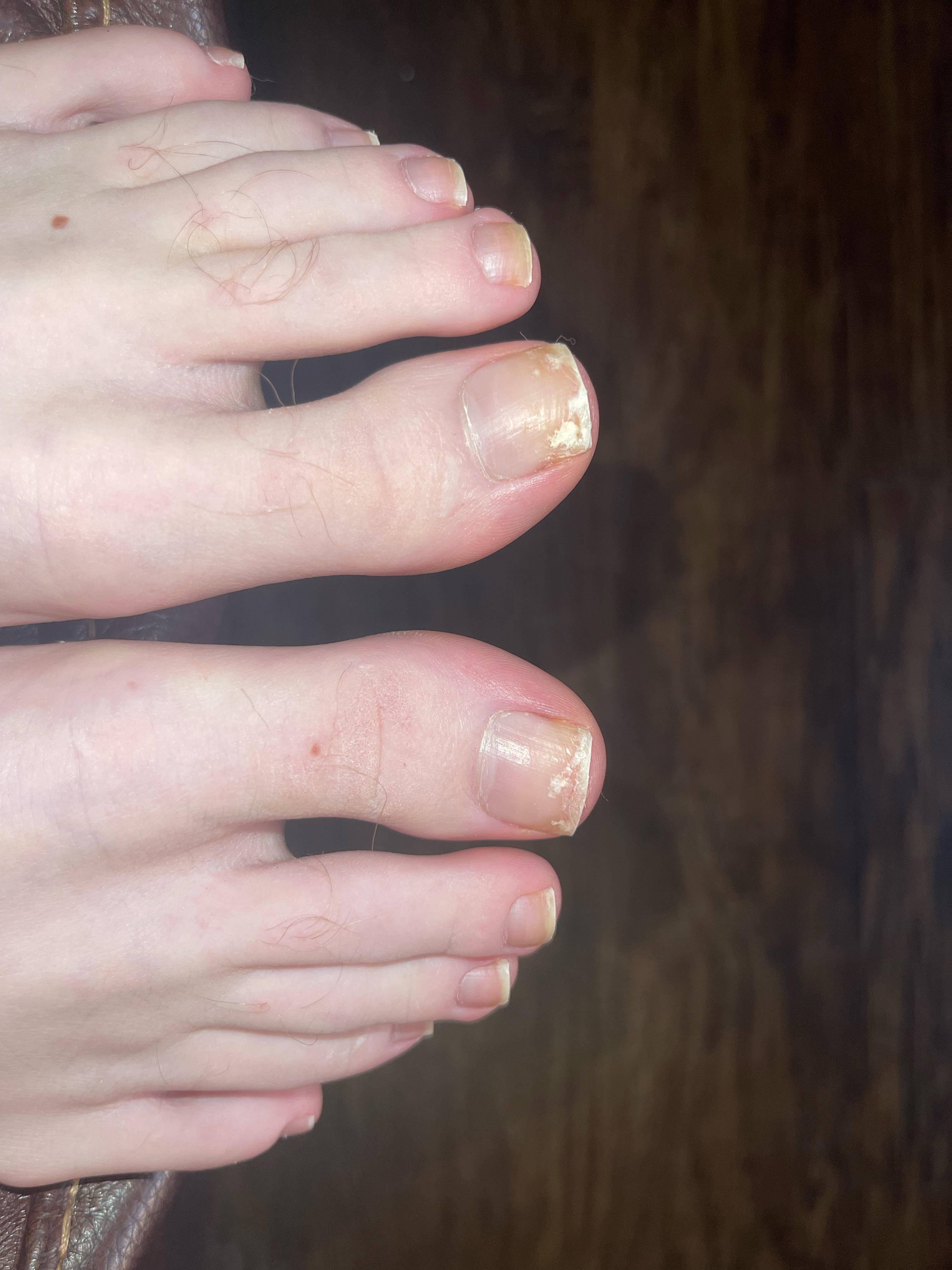 This is Nail Fungus? r/NailFungus