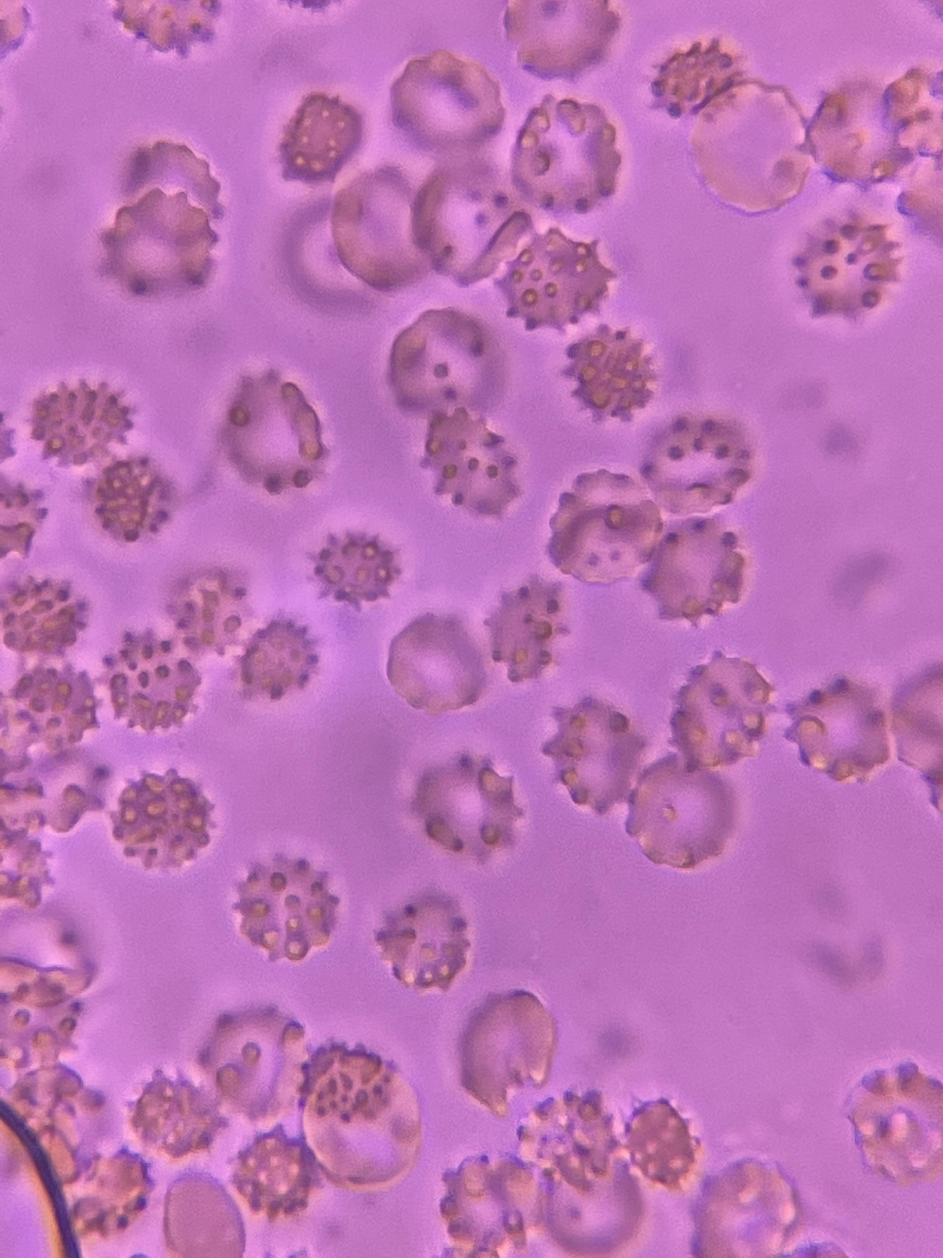 Red Blood Cells And White Blood Cells In Urine