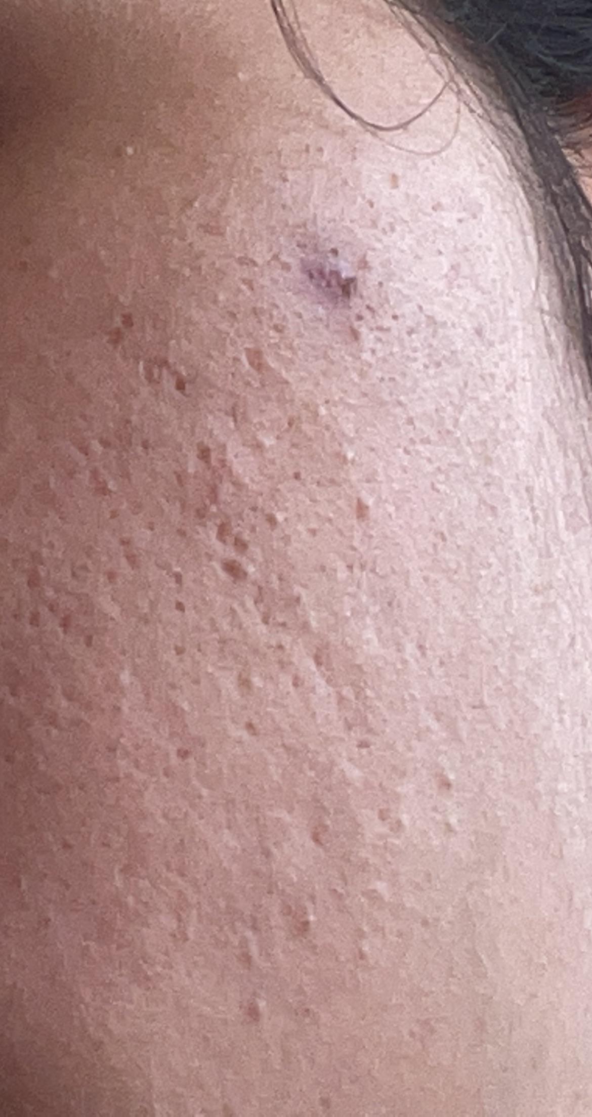 [Acne] i don’t know how to fix this large craters in my face and all of