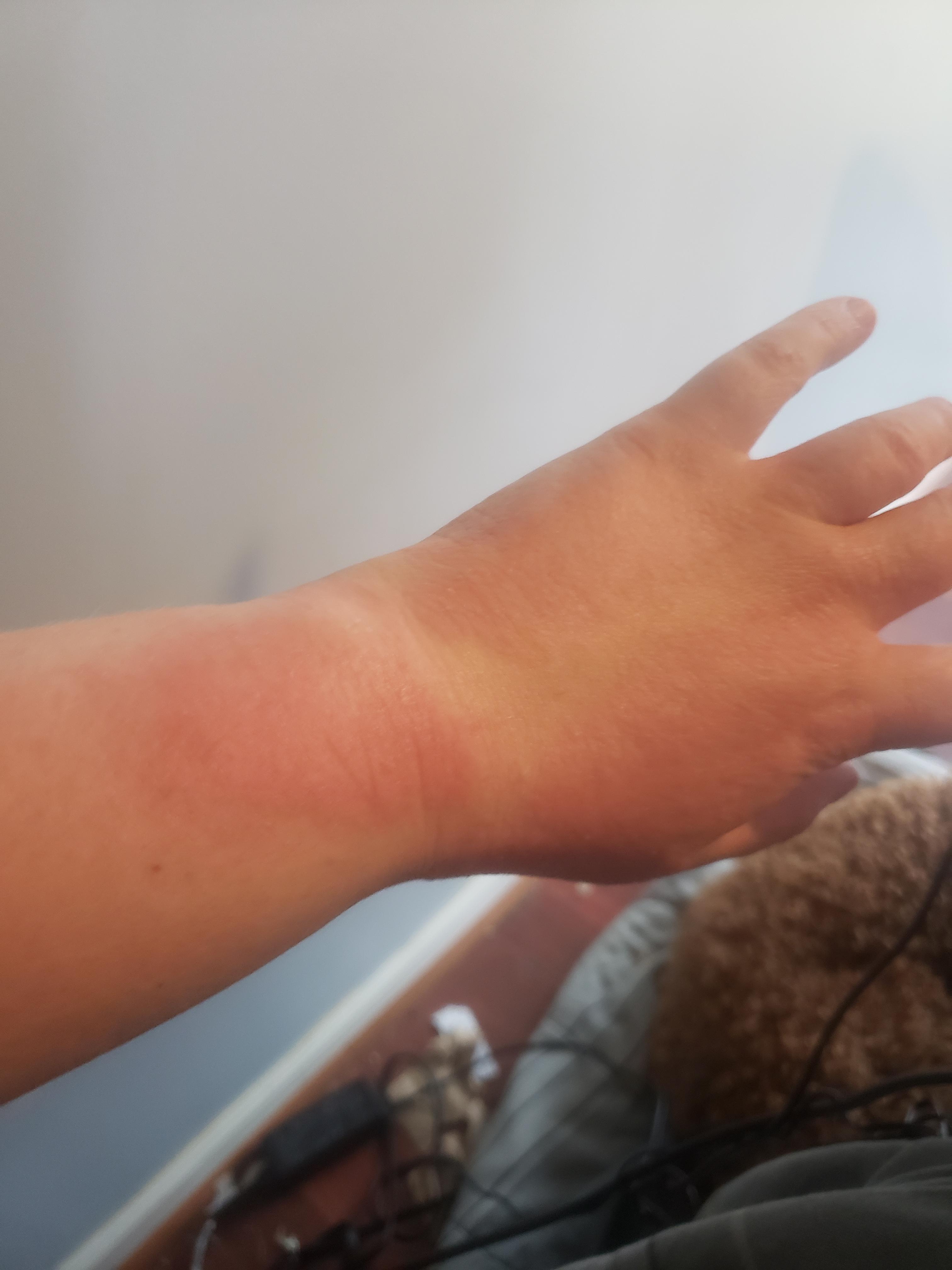 Full body itching and scaly rash for the last month. This rash is