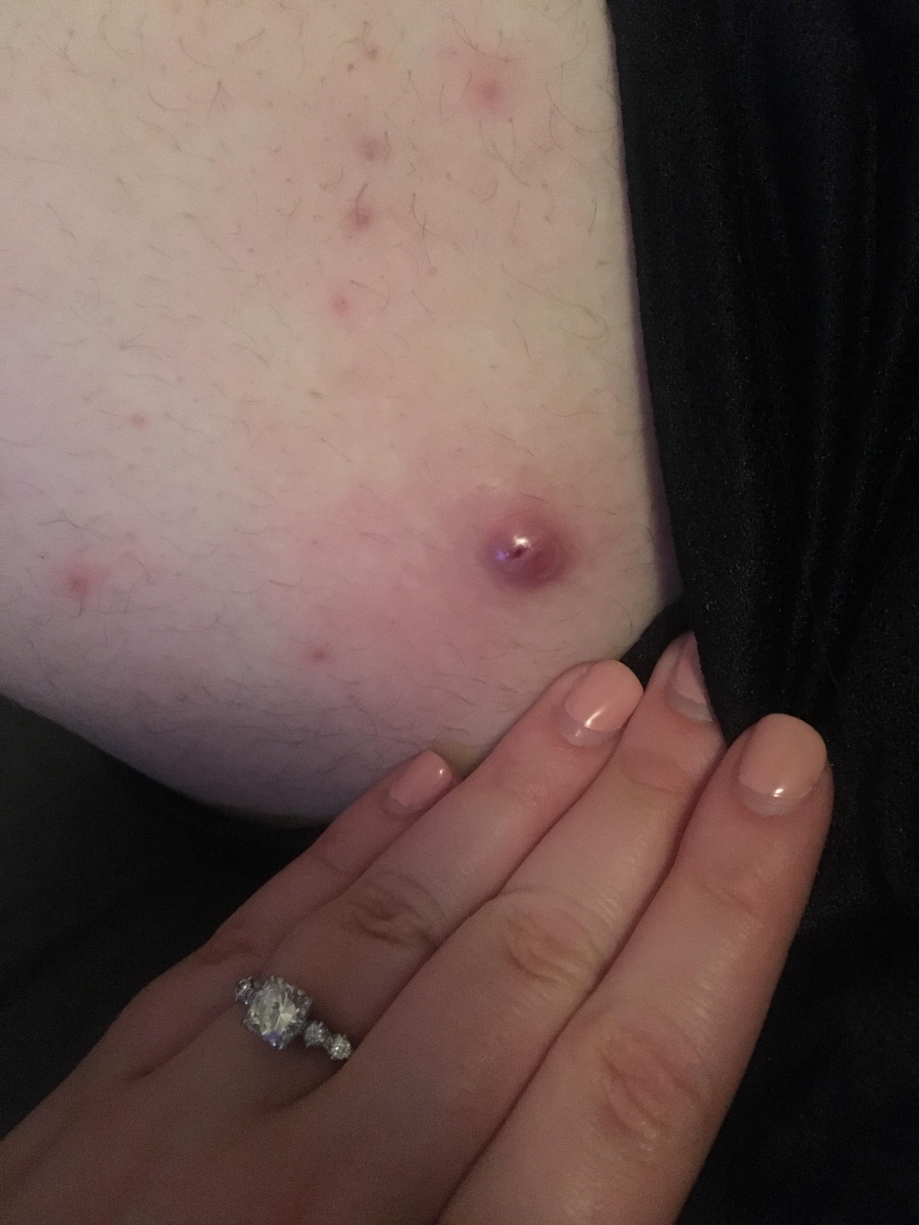 Long time lurker. First time poster. Tried popping this cyst on fiancés