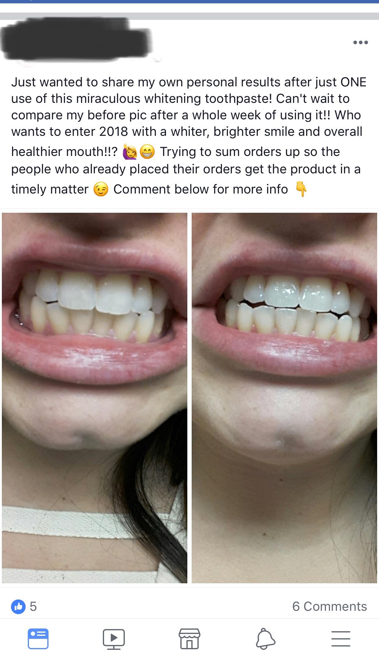 Diy Tooth Filling Reddit How Long Can Cavities Be Left Untreated