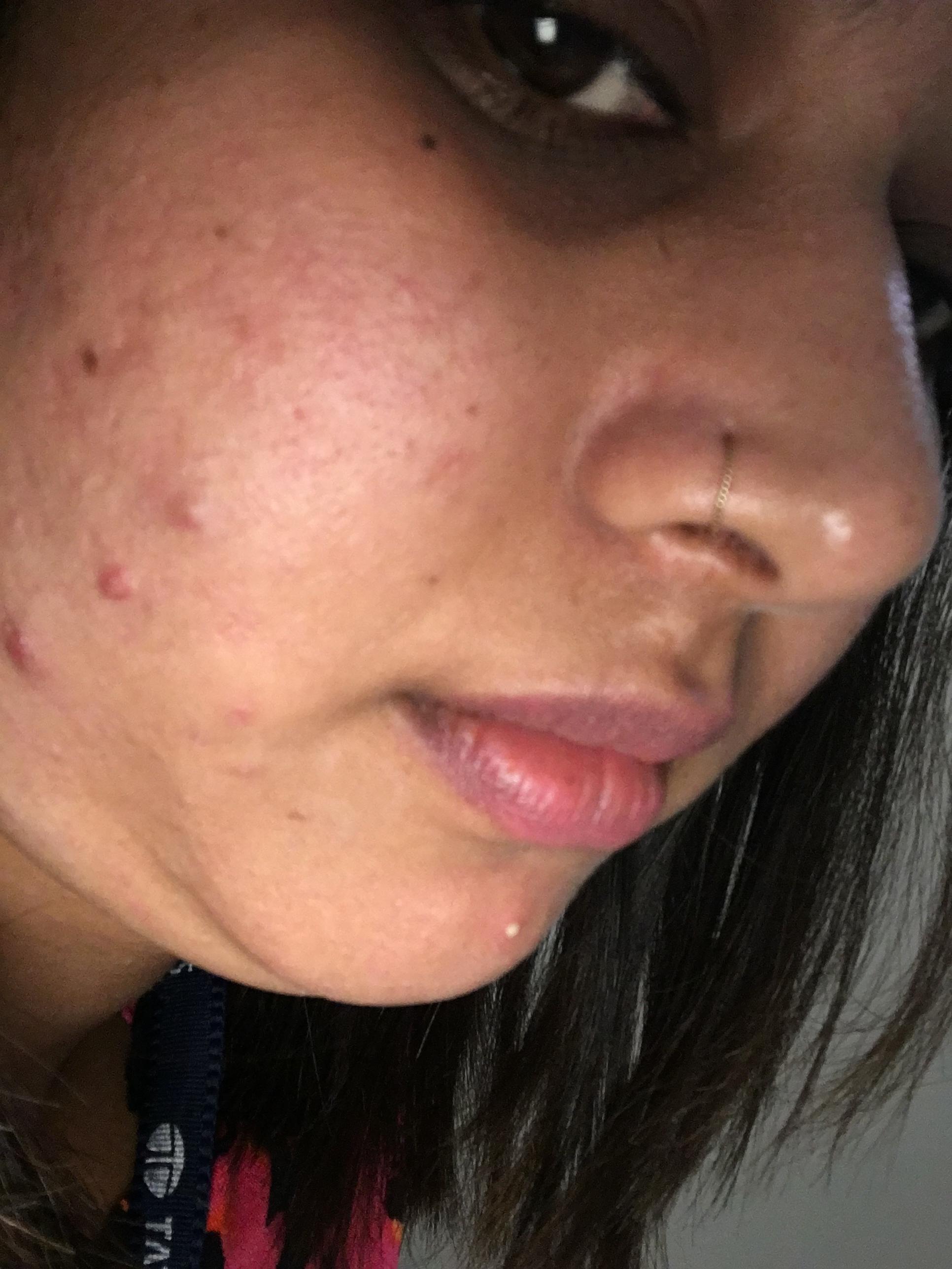 [Skin Concerns] Rosacea, combination skin, acne, dark circles, scars