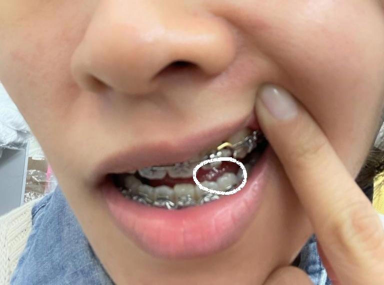 Wire poking out..quick solution before I can fix in on Monday r/braces