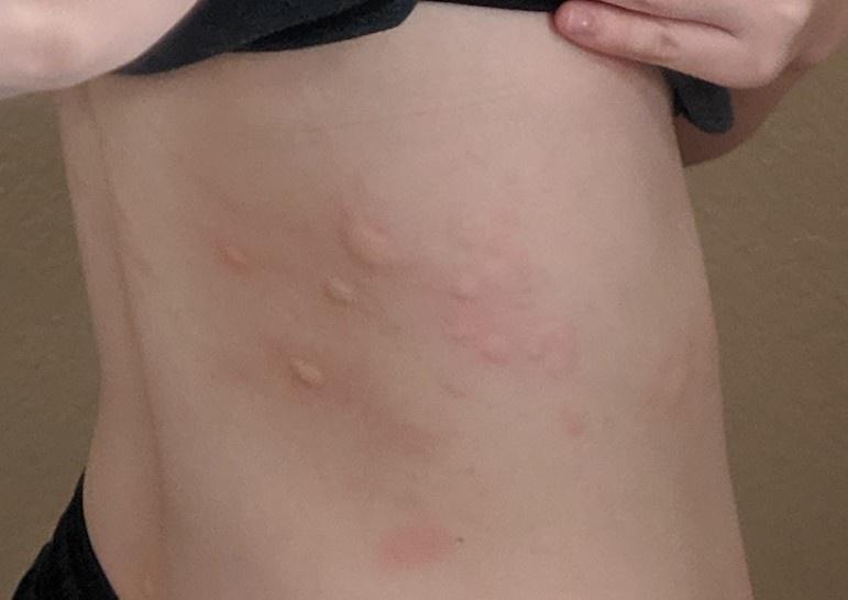 Been sick for the last week. Woke up this morning to terrible hives all