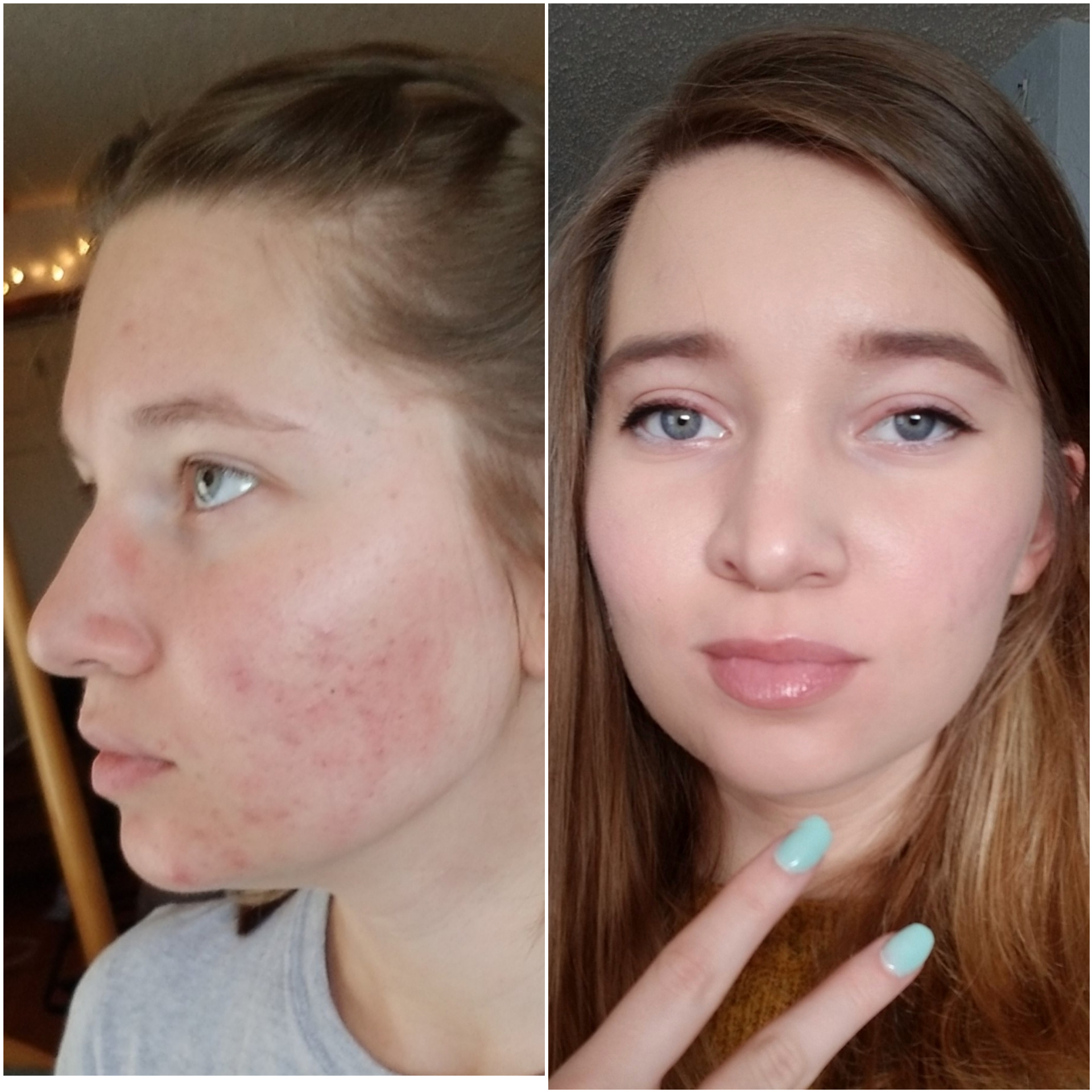 My progress after switching birth control from Sprintec to