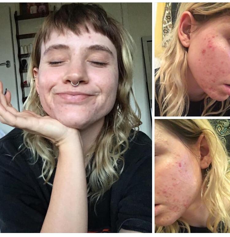 [B&A] Me 10 min ago VS. me 6.5 weeks ago!! Today I have no active