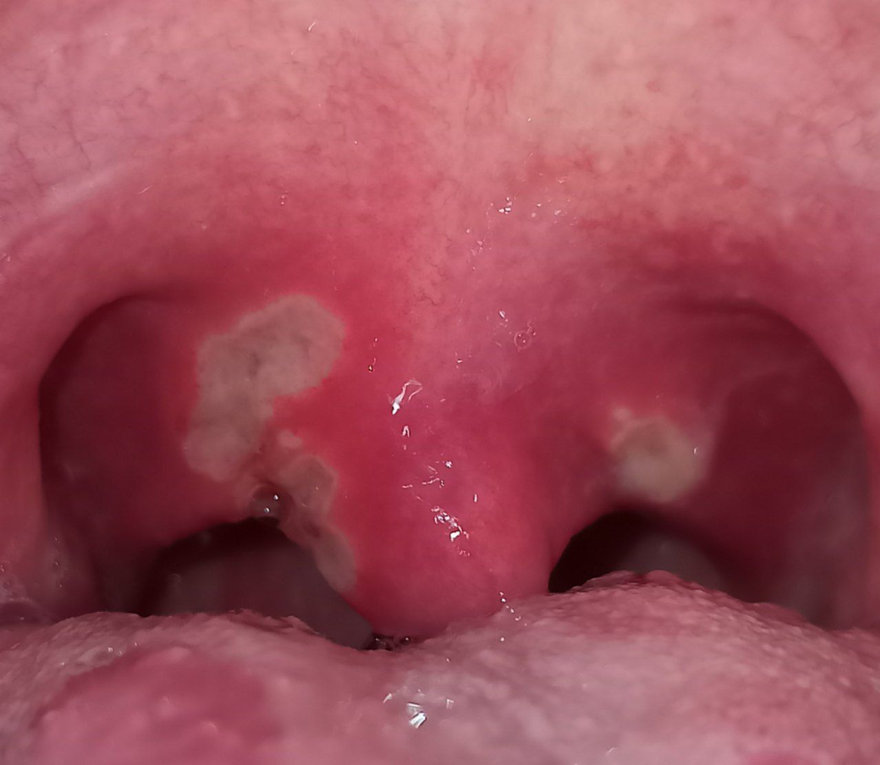 Top 92+ Pictures Photos Of Canker Sores On Tongue Superb
