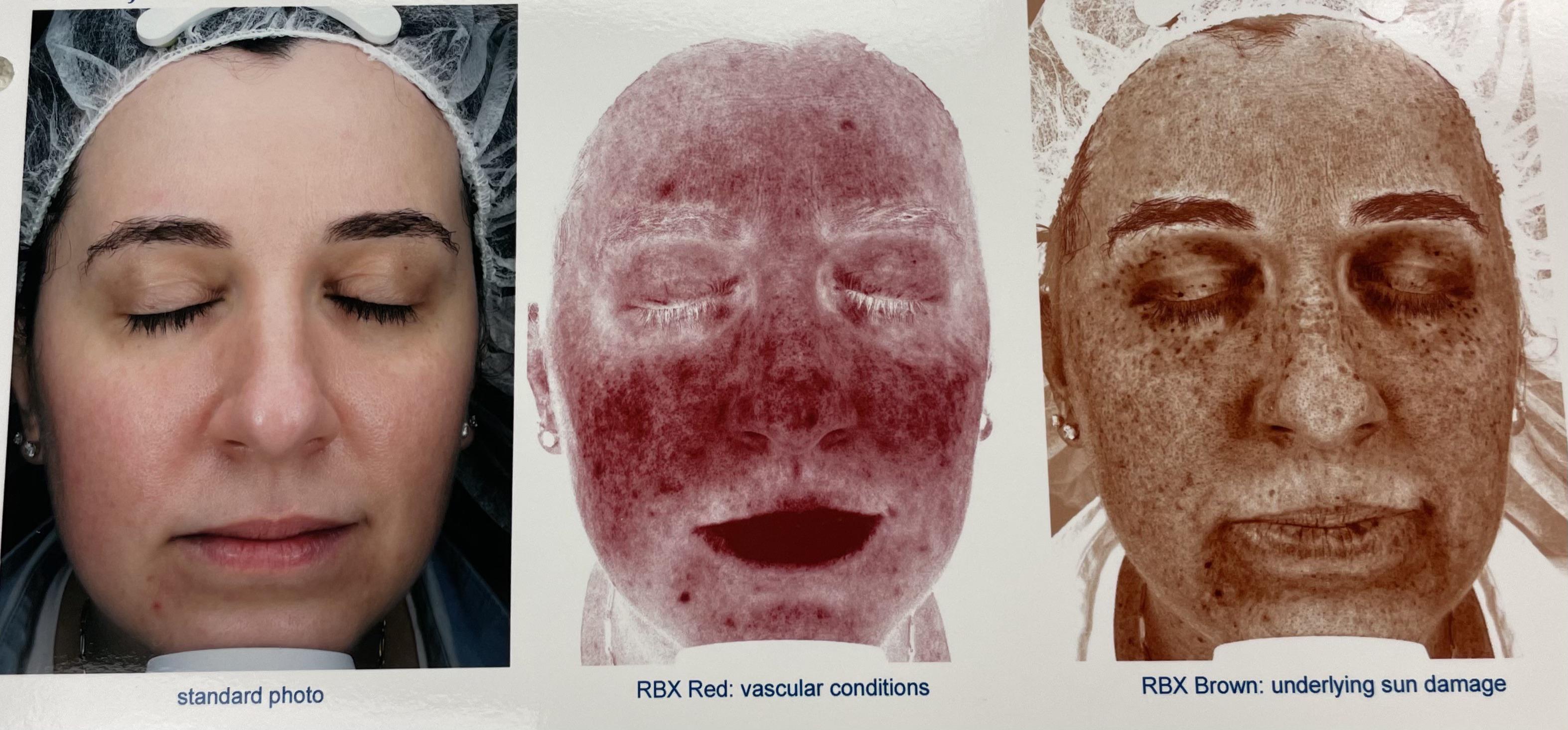 BBL/Halo laser on face, neck & chest for mild rosacea, sun damage & large pores. r/30PlusSkinCare