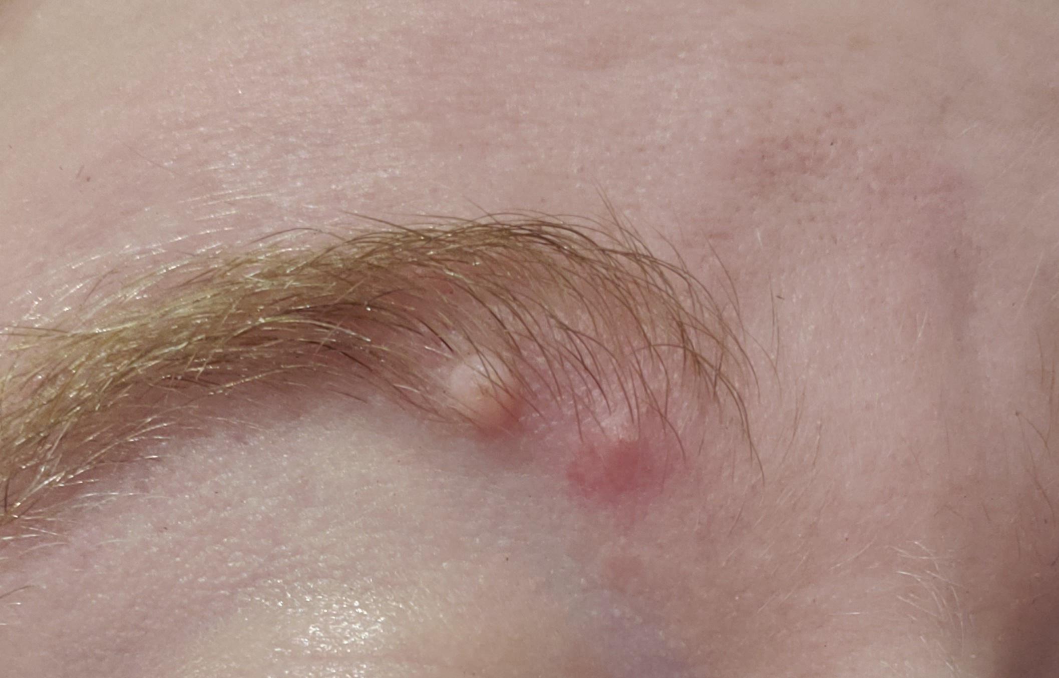 Anyone know what these bumps on my eyebrow are? DermatologyQuestions