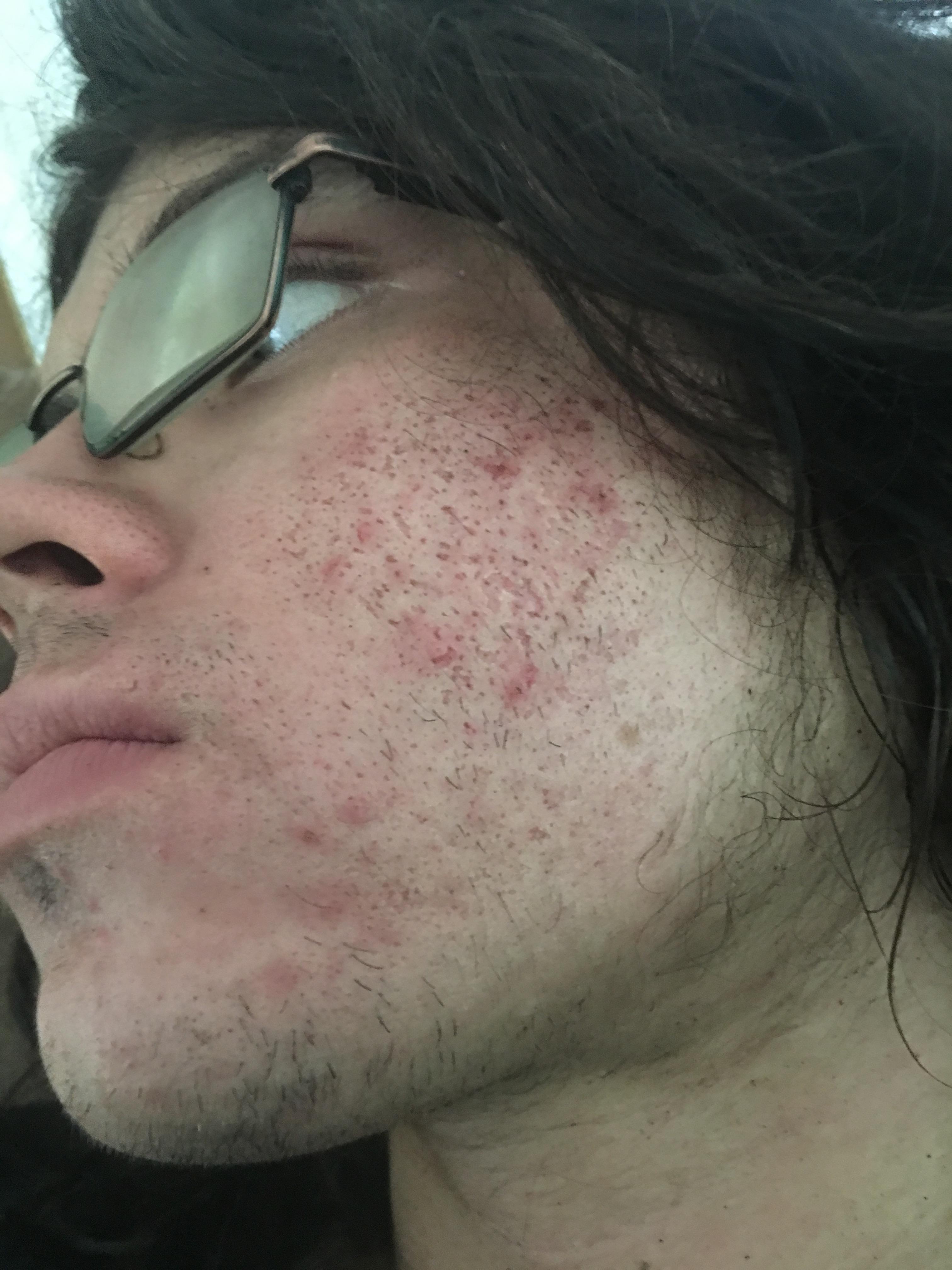 [skin concerns] i have such bad scarring. Will a chemical peel done by