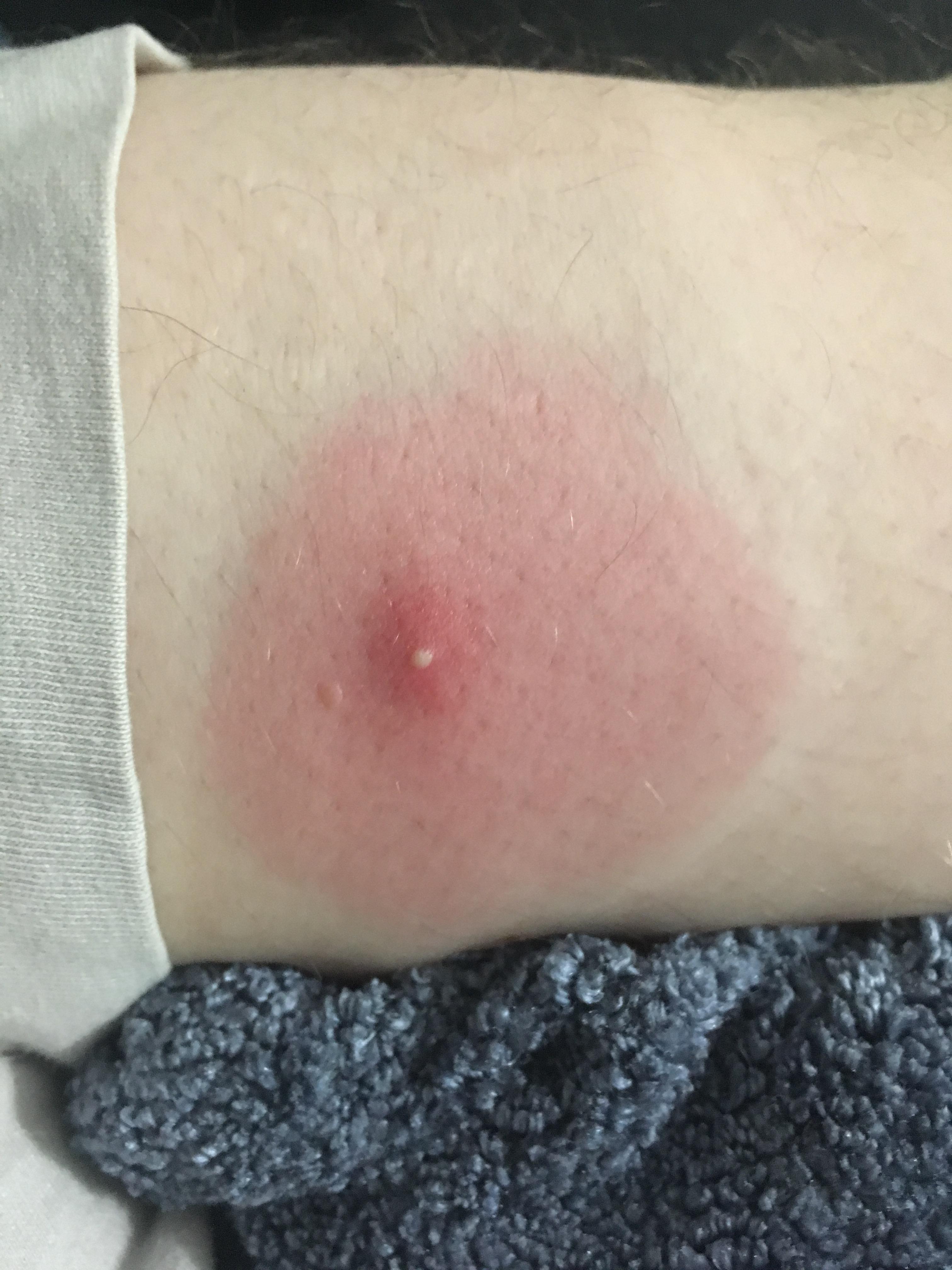 Spider/bug bite, presumably from being at baseball game 2 days ago