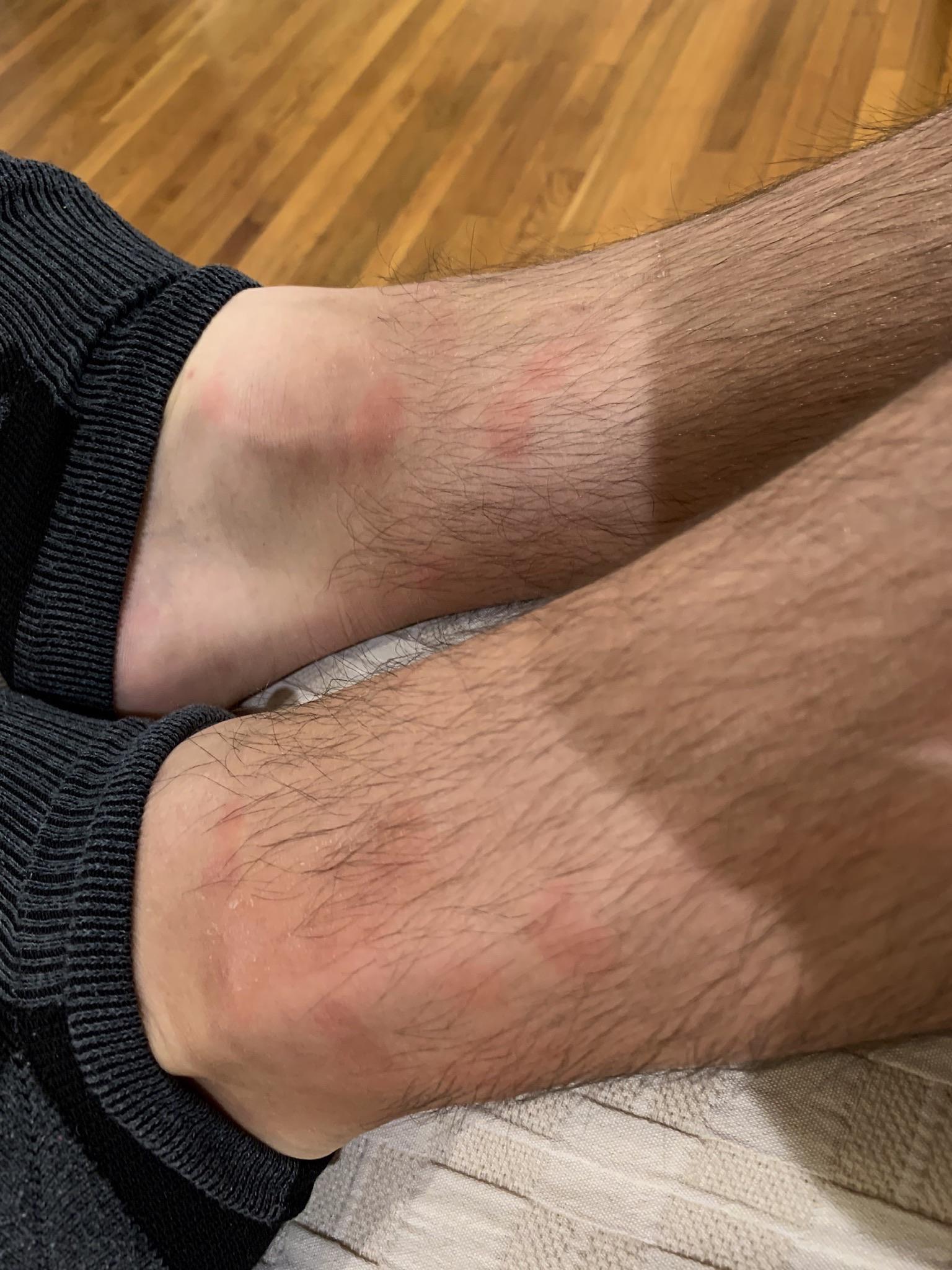 Anyone else getting destroyed by ankle biting mosquitos? : burbank