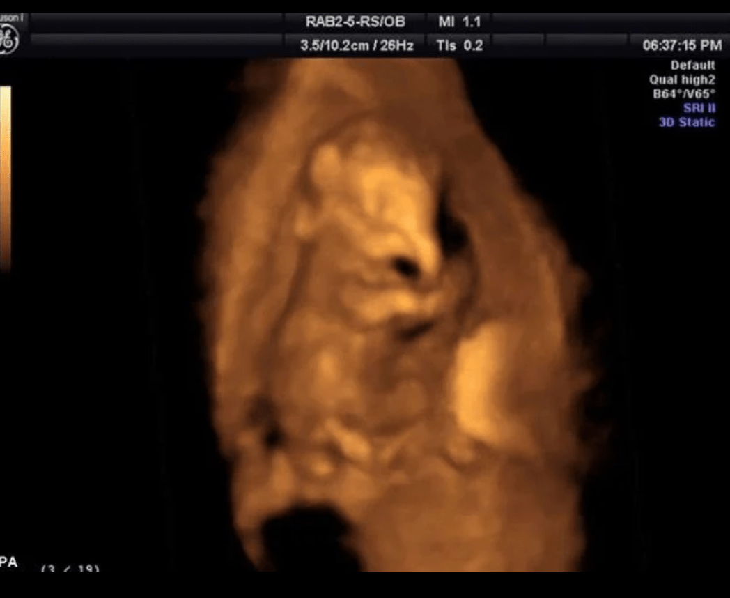 Ultrasound of a baby elephant r/interestingasfuck