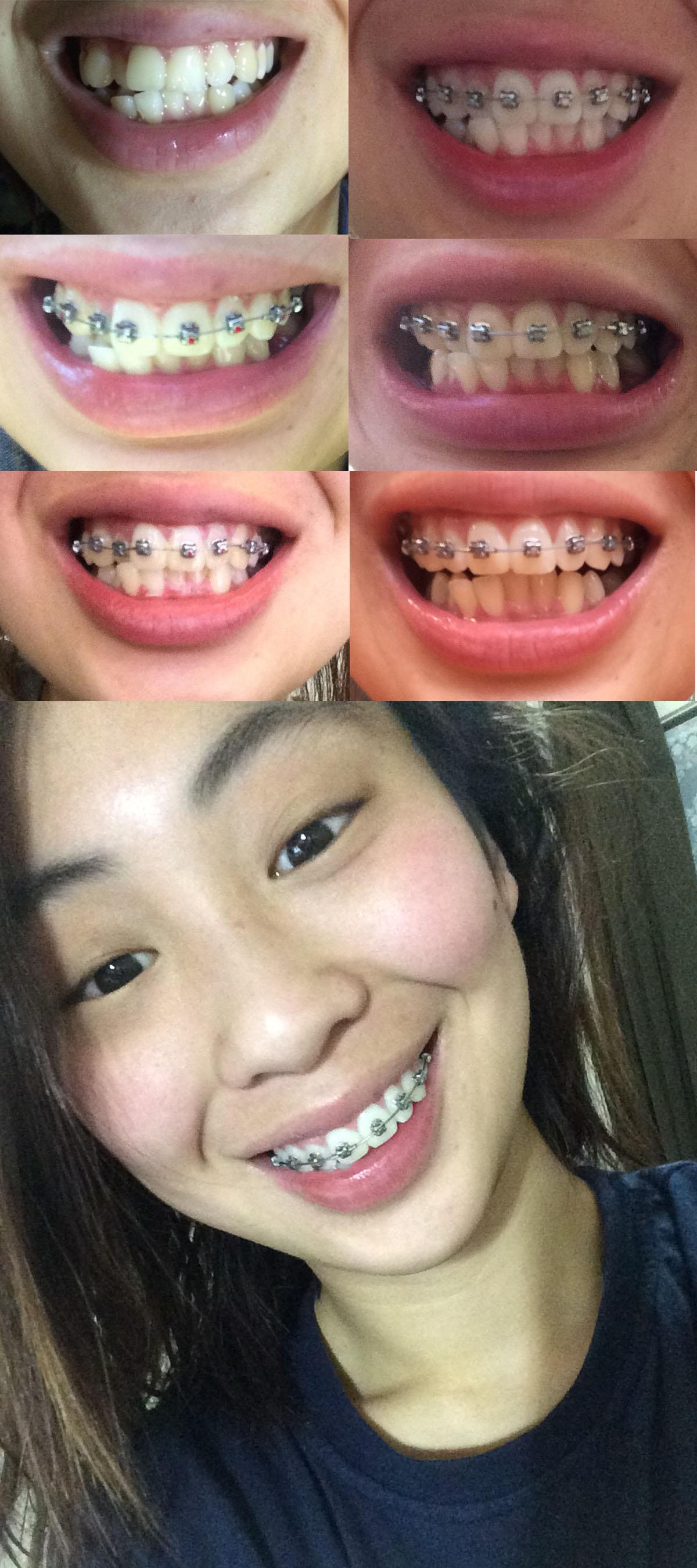 Top braces progress after 8 weeks! r/braces