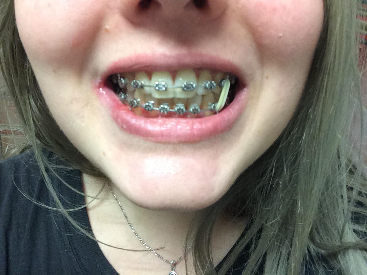 Pain in upper molars one week after elastics? r/braces
