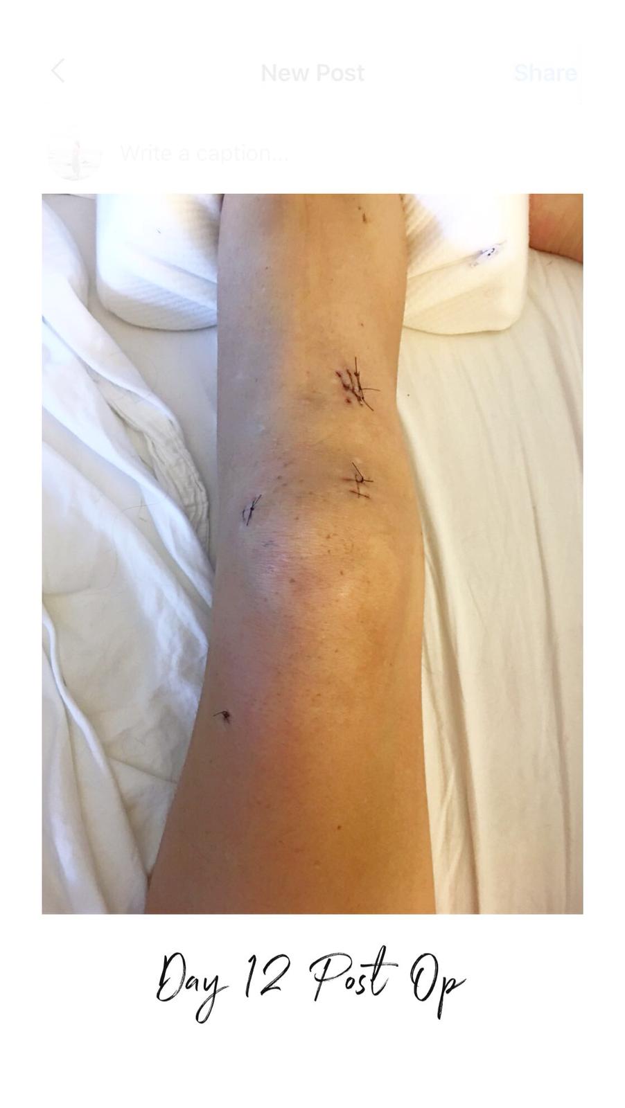 Day 12 PostOp — hello, kneecap! r/ACL