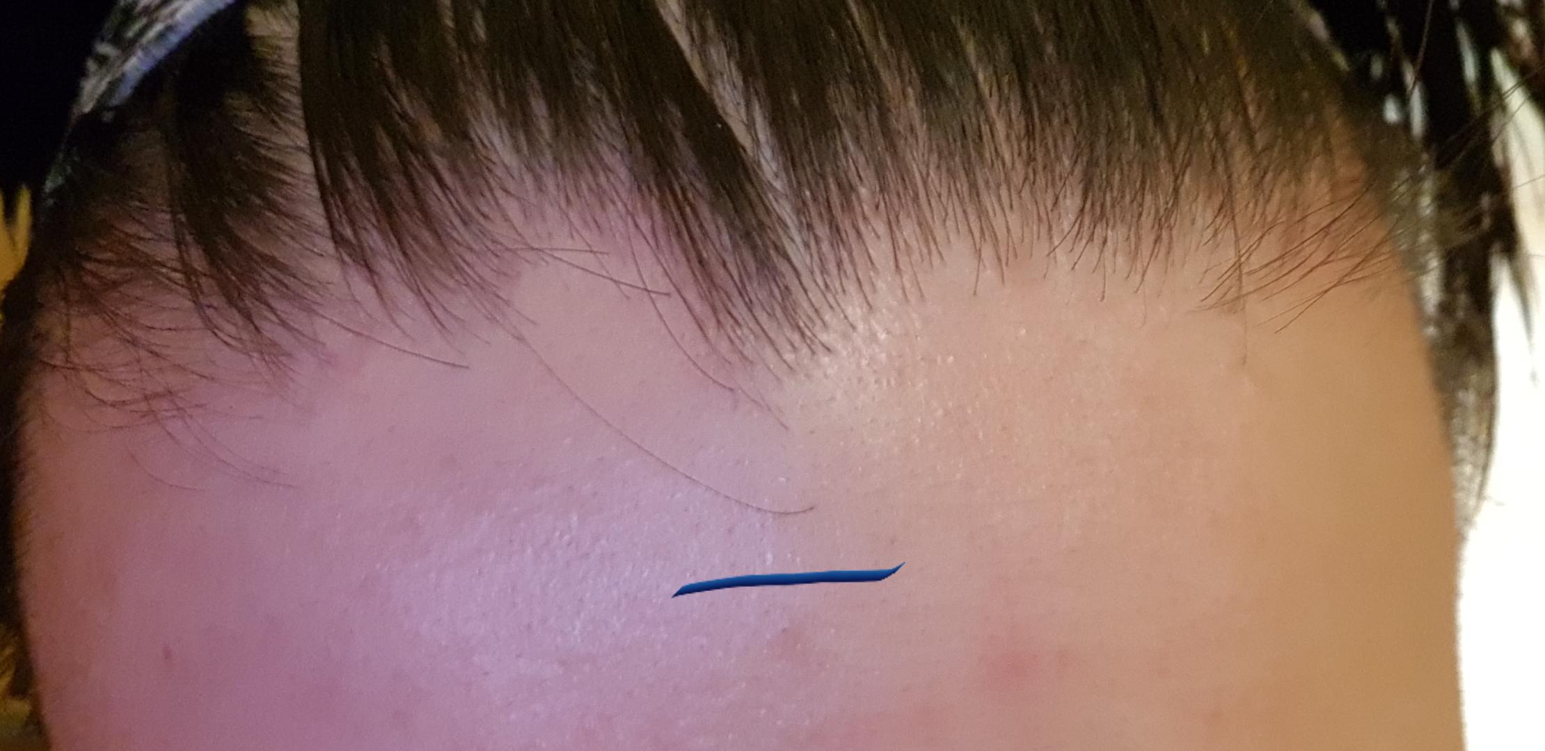 Should i plug this hair 510mm under every other hair in my hairline