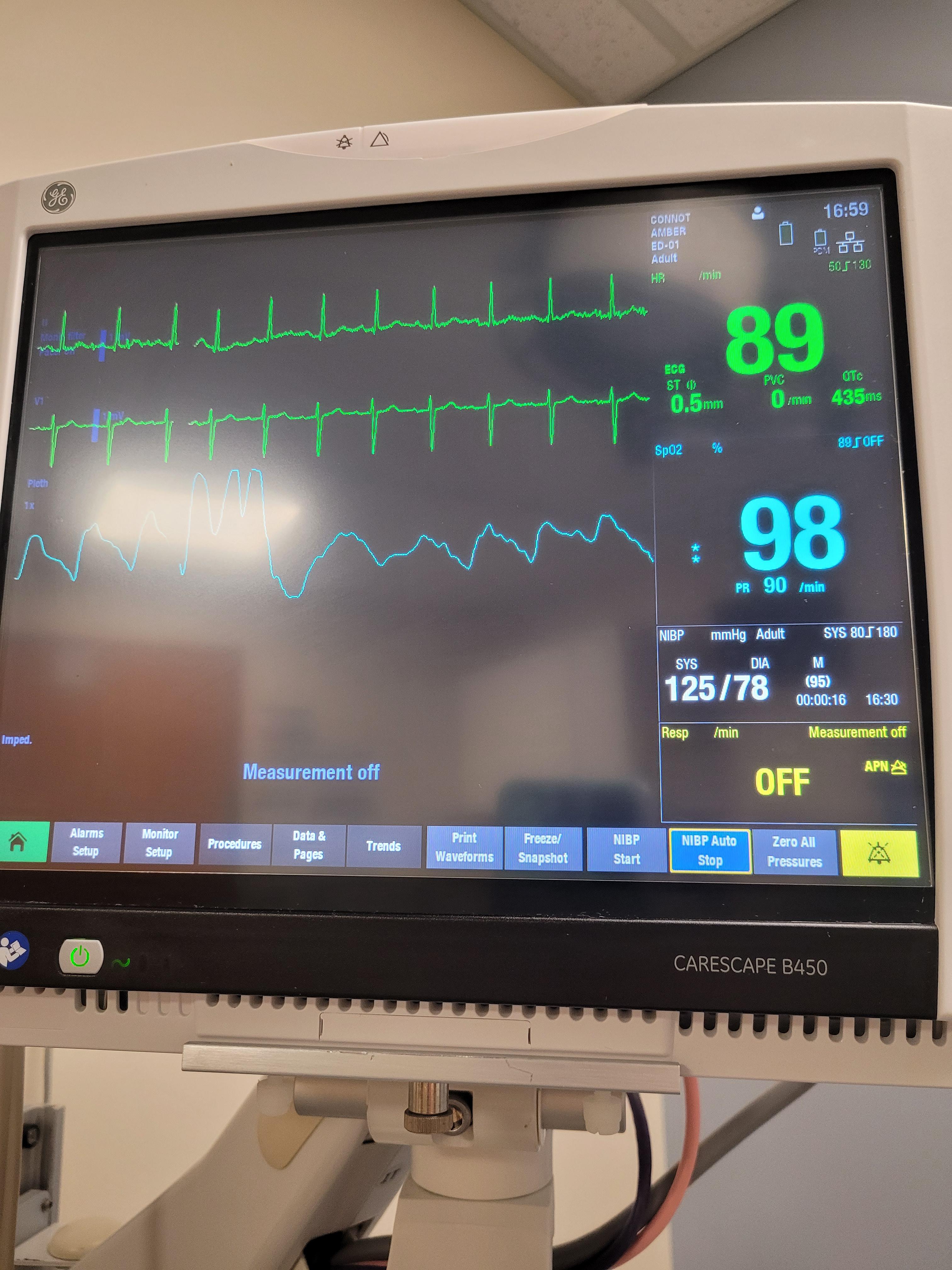 why are the lines in between so crazy looking on heart monitor? r/PVCs