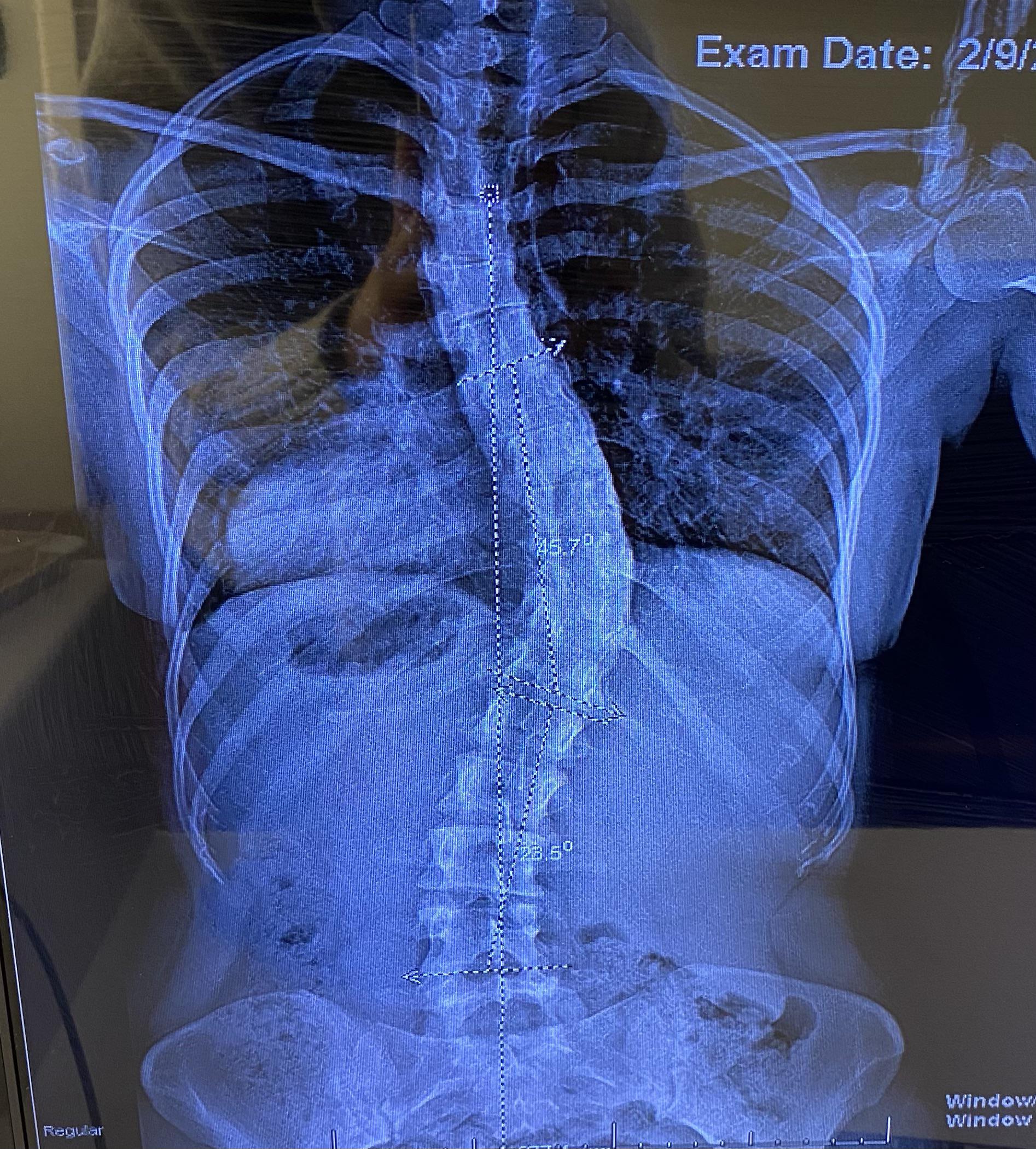 Slight curvature still present after Harrington rod placement and