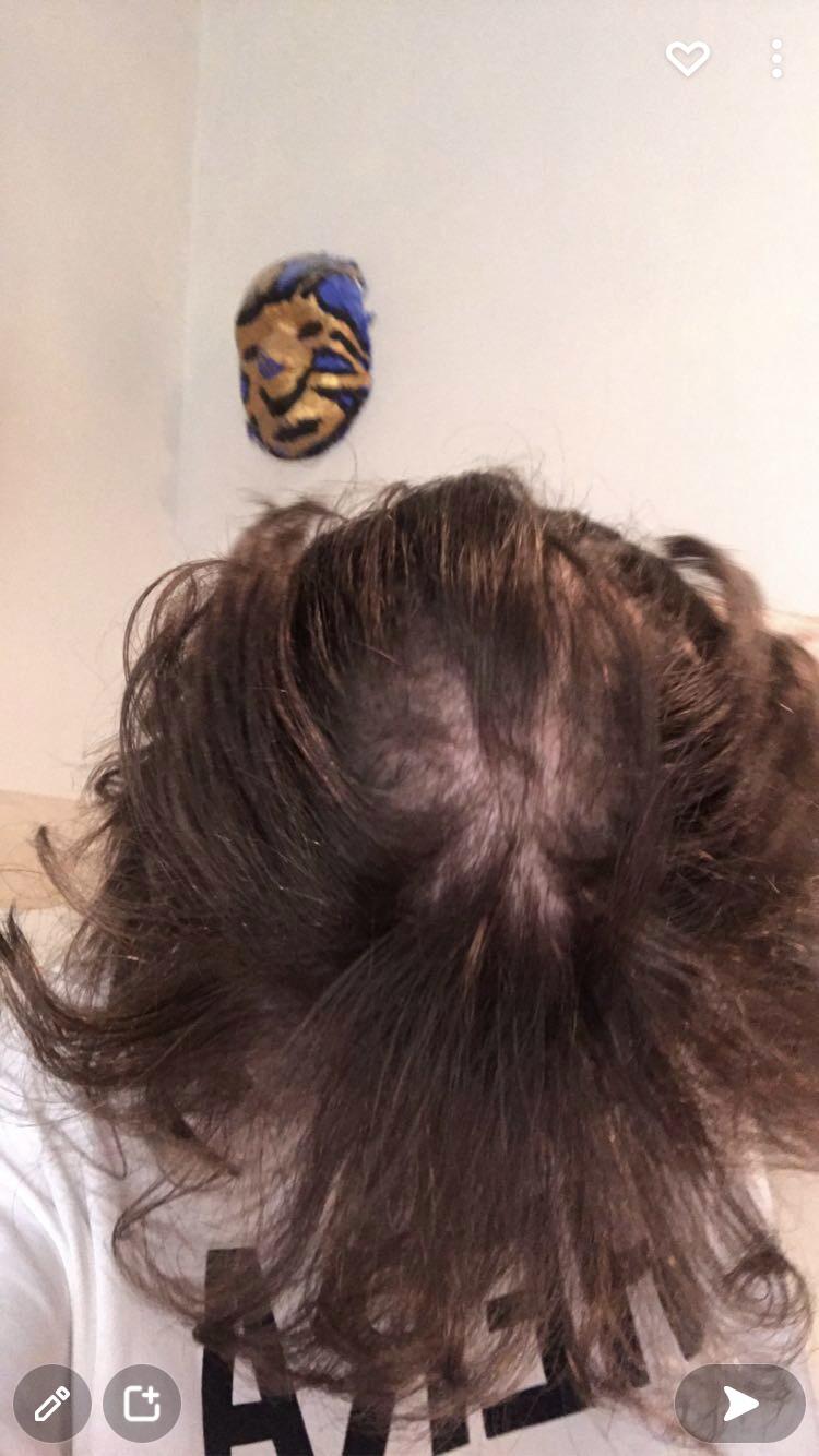 I pulled my hair out at the scalp and some scalp skin came off. This