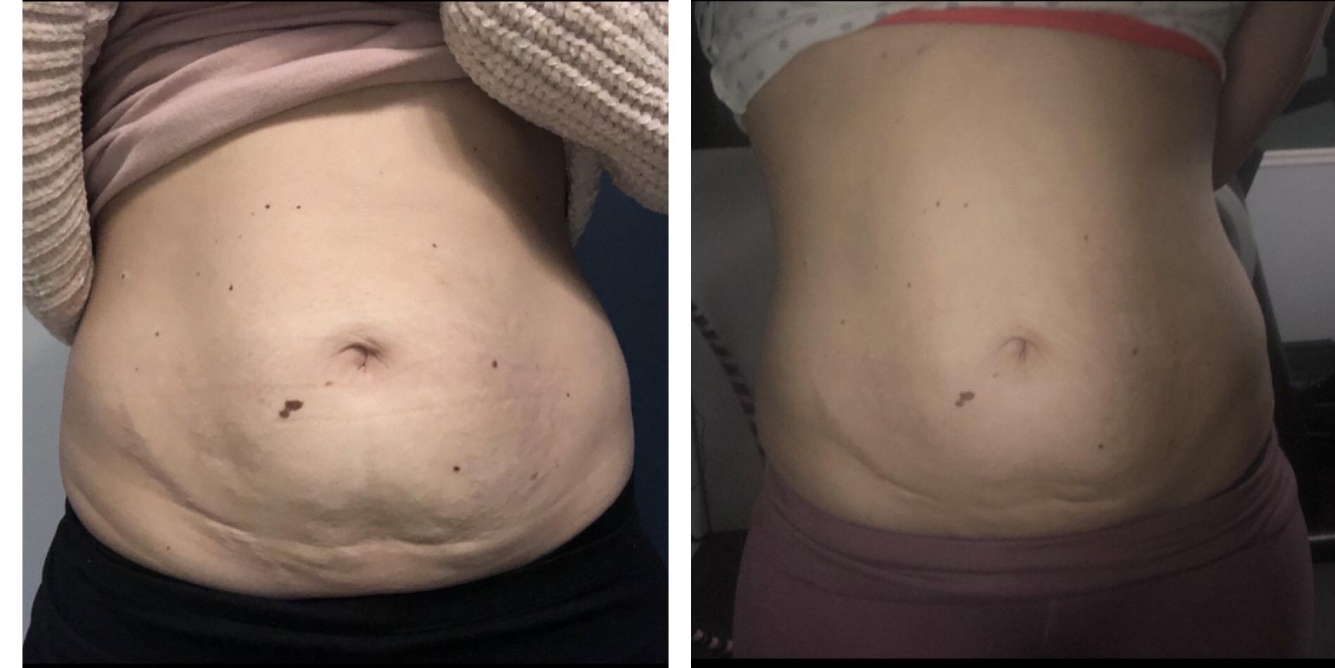 1 month progress. 1.5 mm on pregnancy stretch marks 2 kids). I also