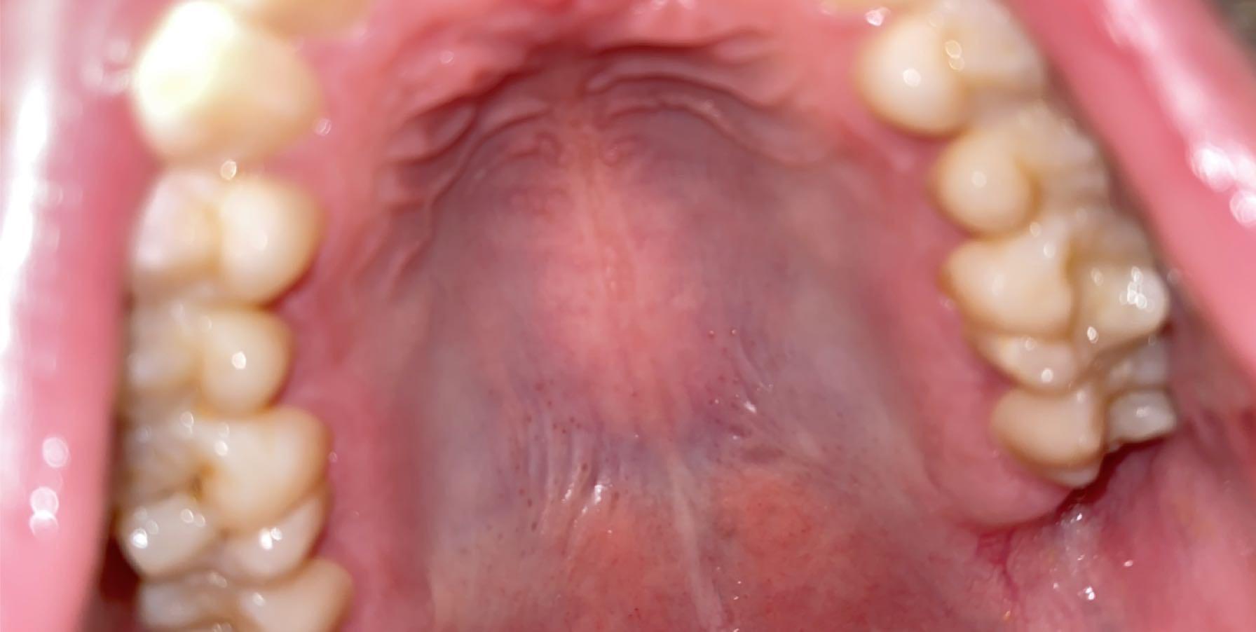 What are these black dots on the roof of my mouth. My throat also hurts