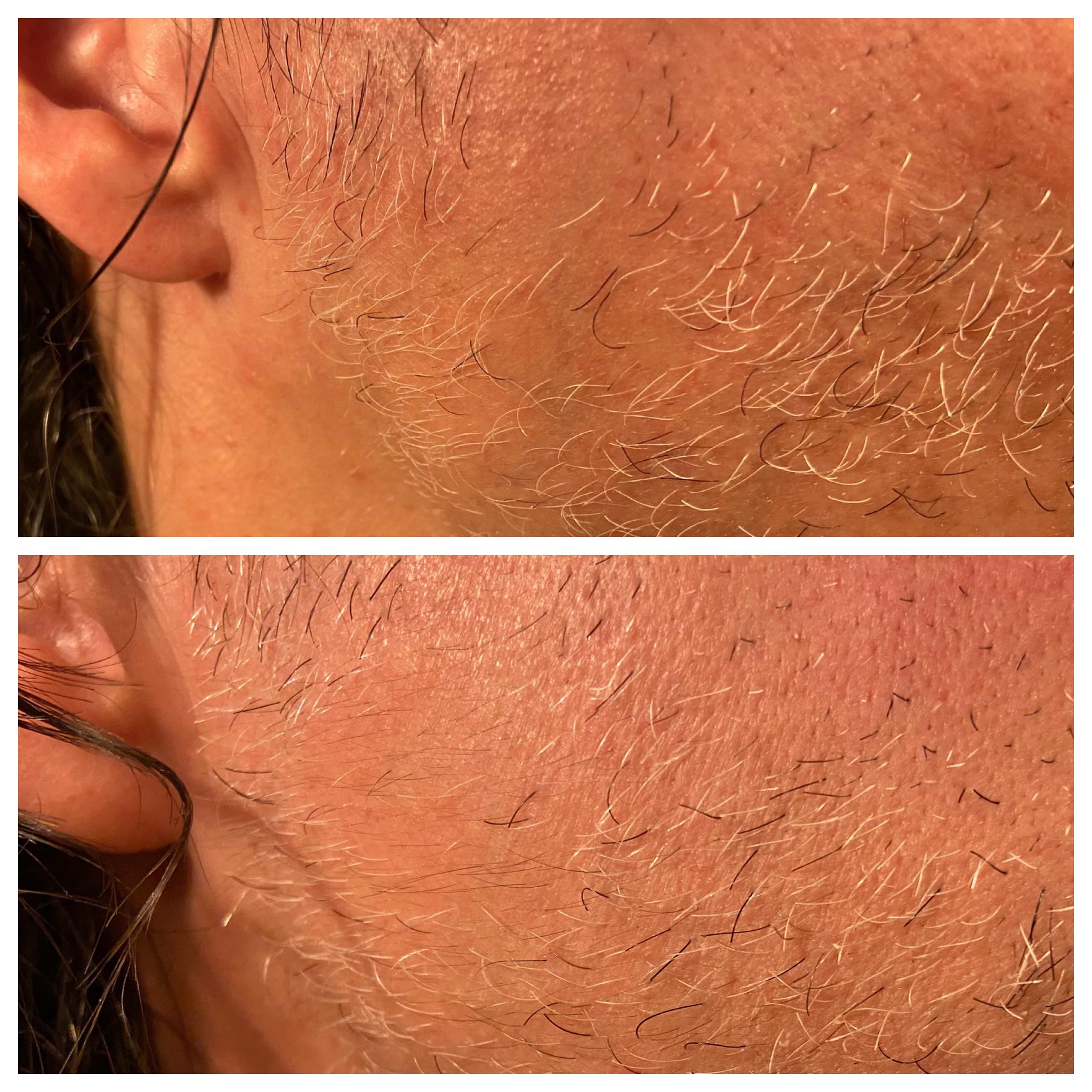 2 month progress. 45 years old / 1ml daily. I’m starting to get vellus