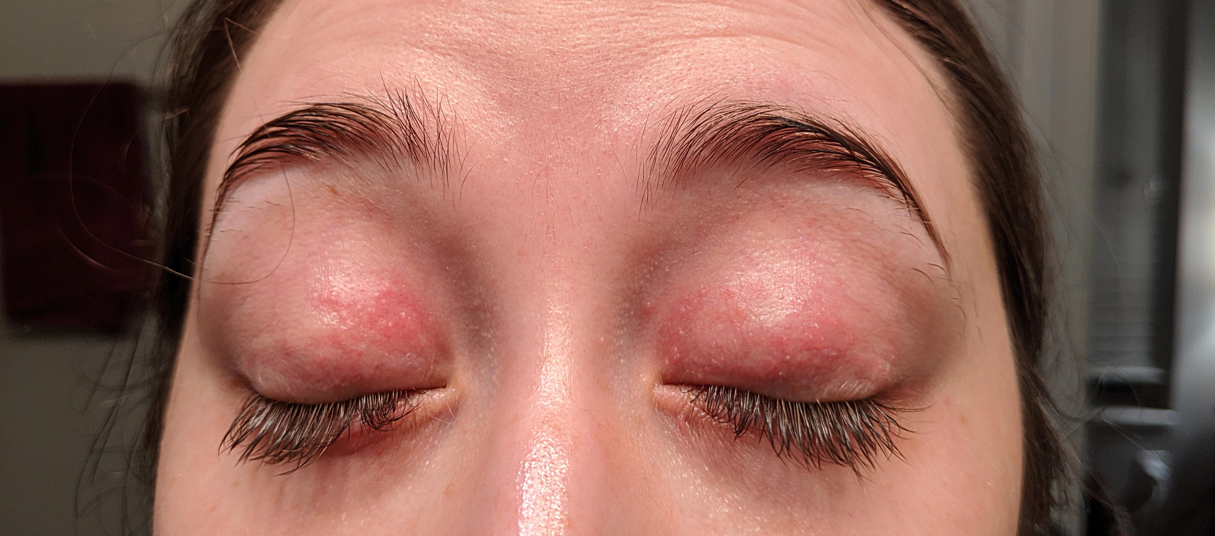 Periocular Dermatitis Around Eyes
