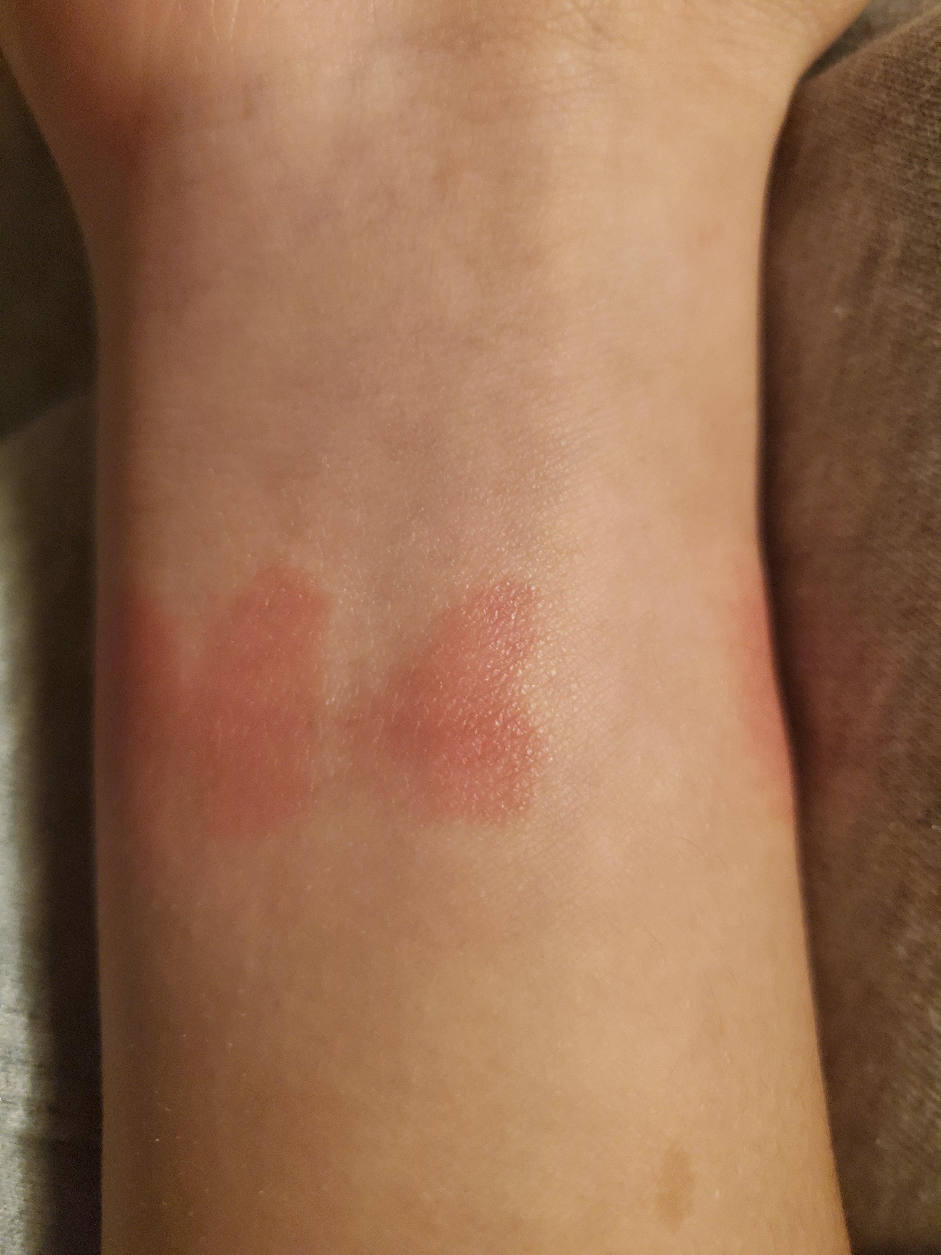 WATCH BAND CAUSING SPOTS? r/WearOS