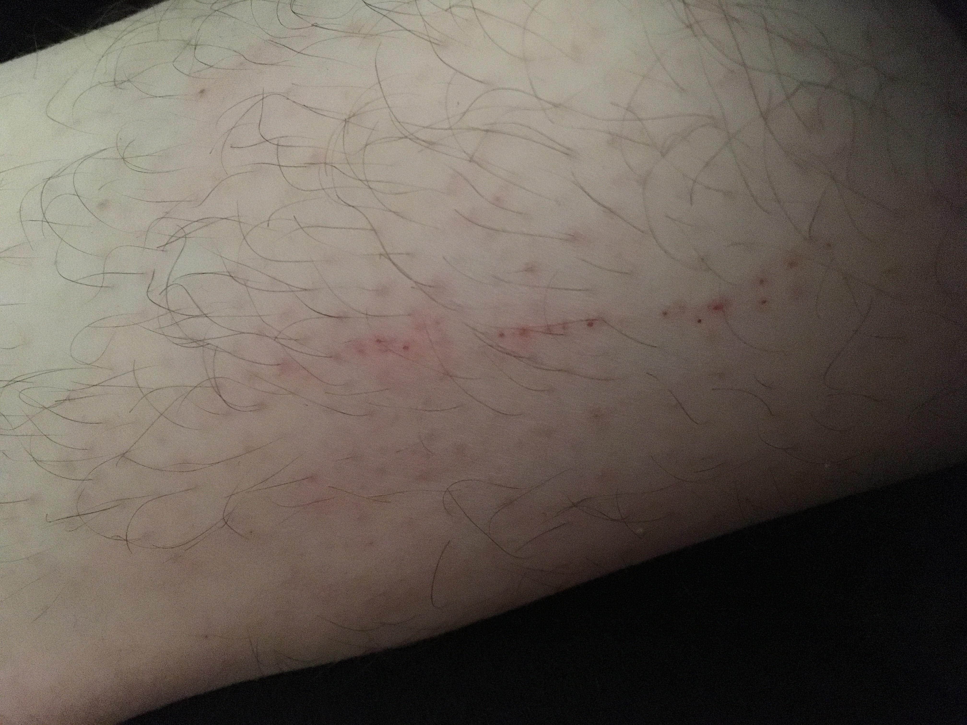What Is Biting Me At Night In My Bed It Swells And Itches