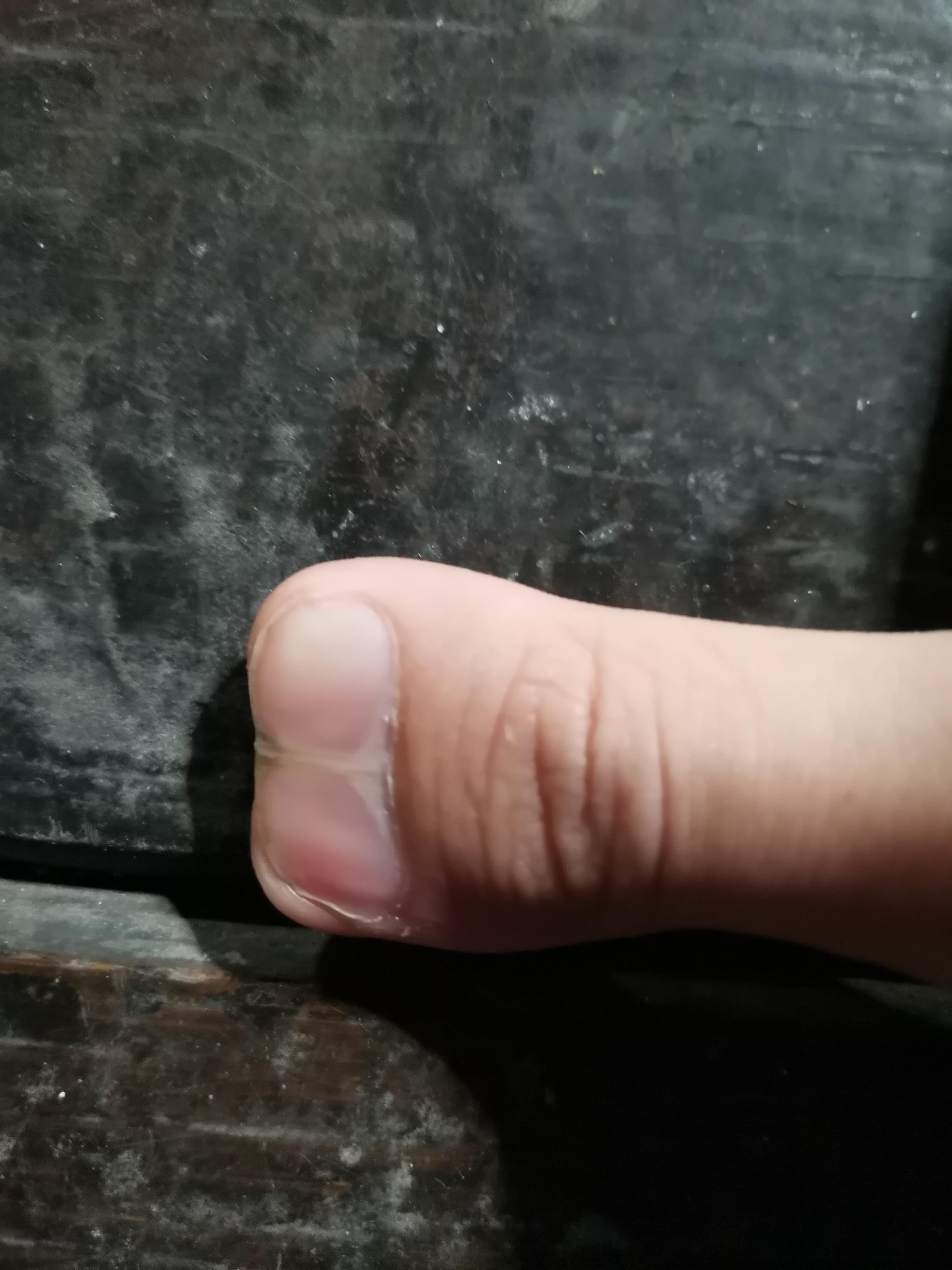 My weird finger r/Weird
