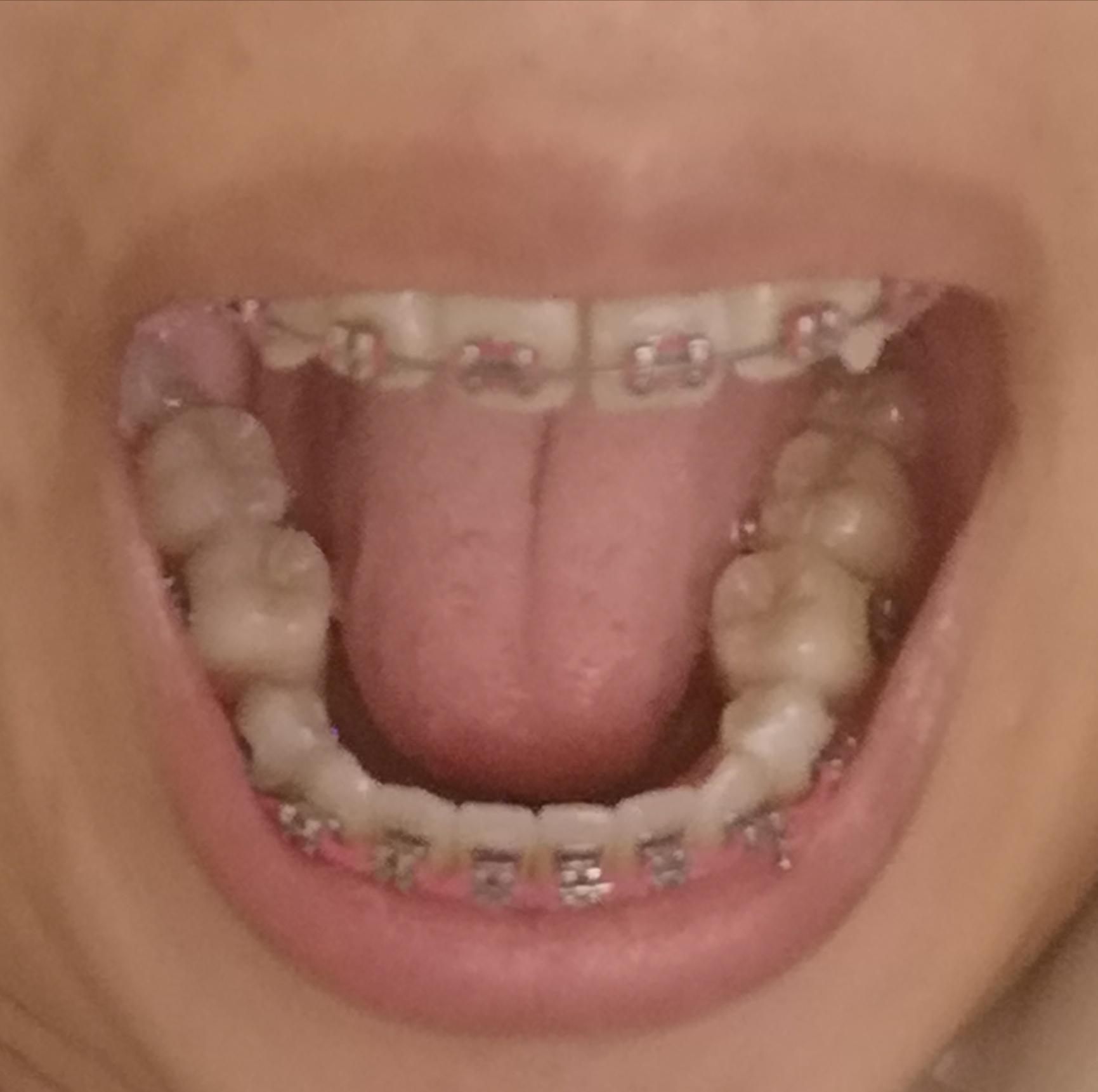 I'm about 9 months into braces and I noticed that the unbracketed