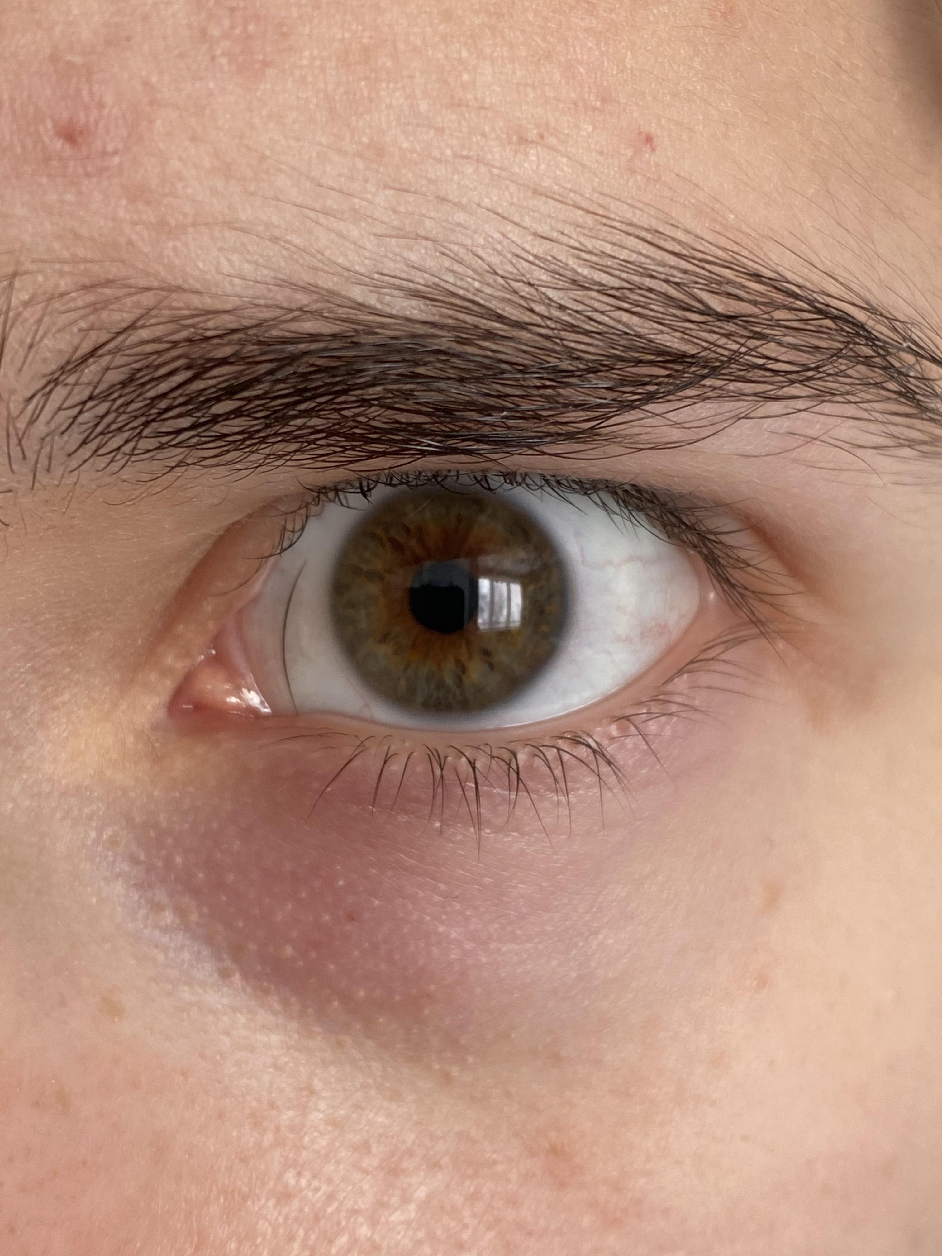 This eyelash that’s stuck on my eye r/mildlyinteresting