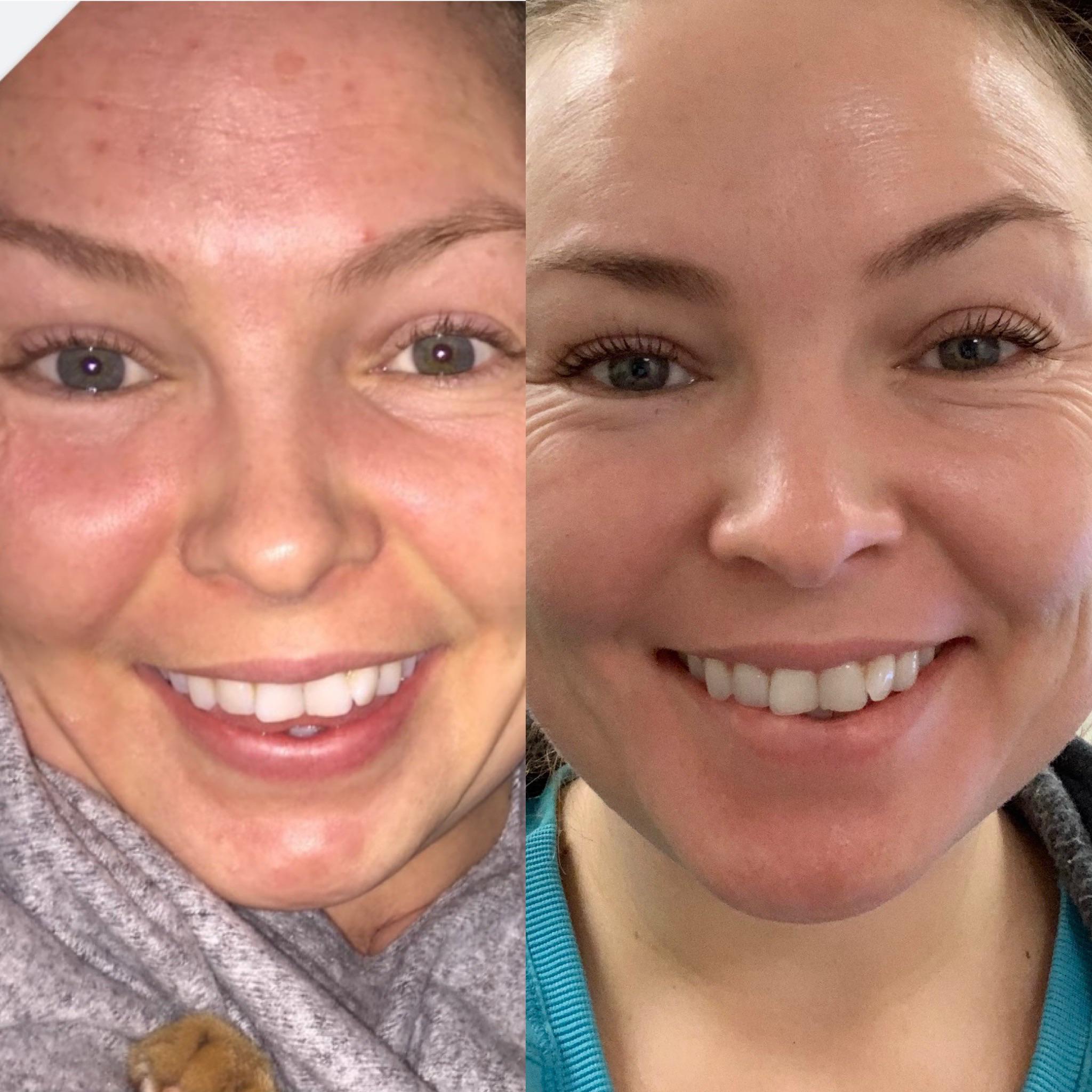 15+ months of Tret. 36/F. Routine in comments. r/tretinoin