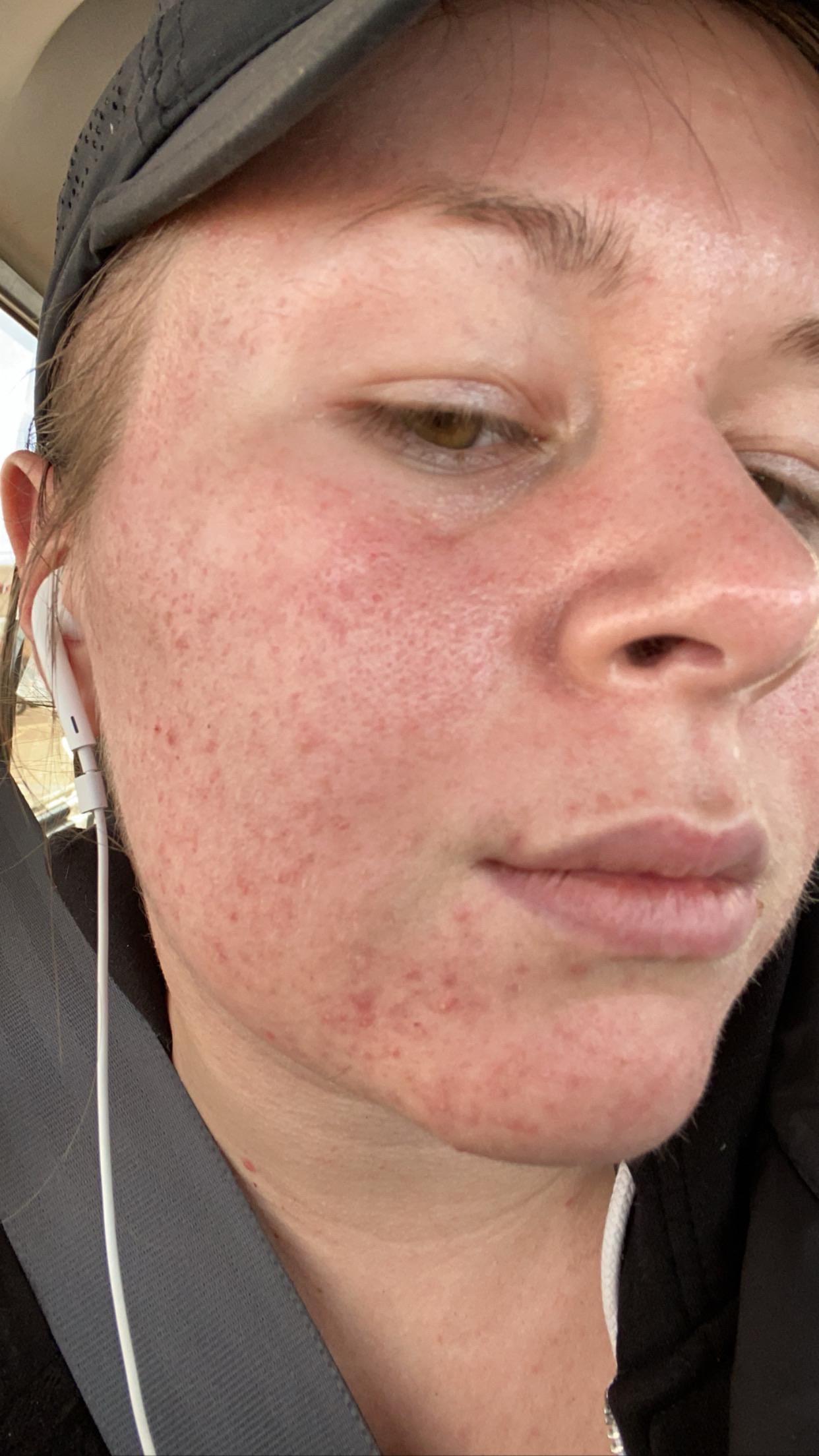 [Acne] I had seborrheic dermatitis which I fixed by using Nizoral on my