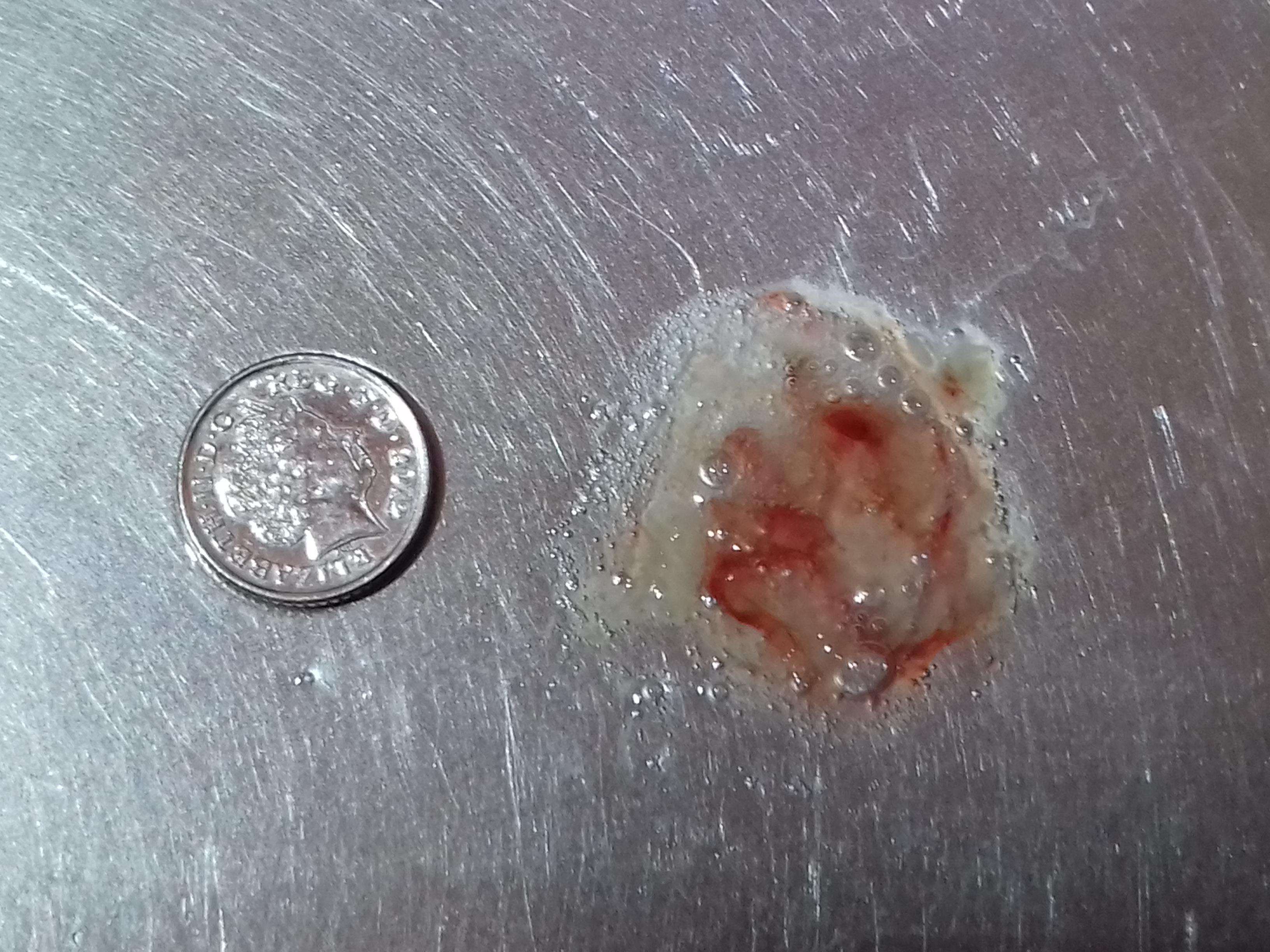 Chest pain and coughing up bloody phlegm (I have been to hospital