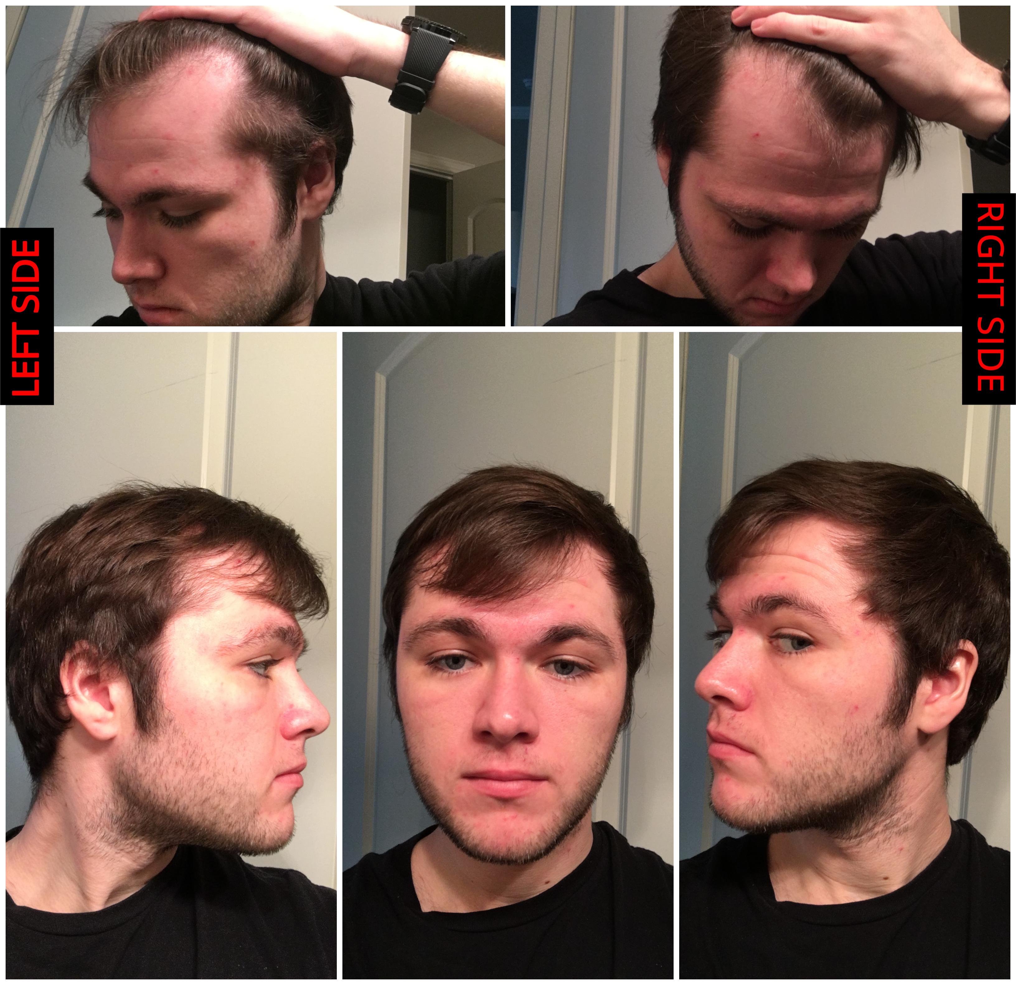 I never cared about my hair before I started to lose it. Need haircut