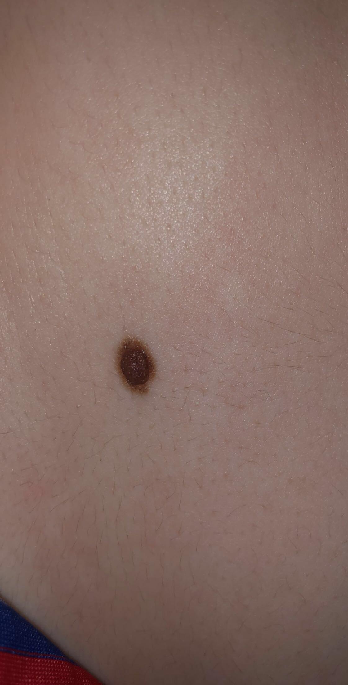 Is this an abnormal mole? It’s raised, perfectly round, but has a