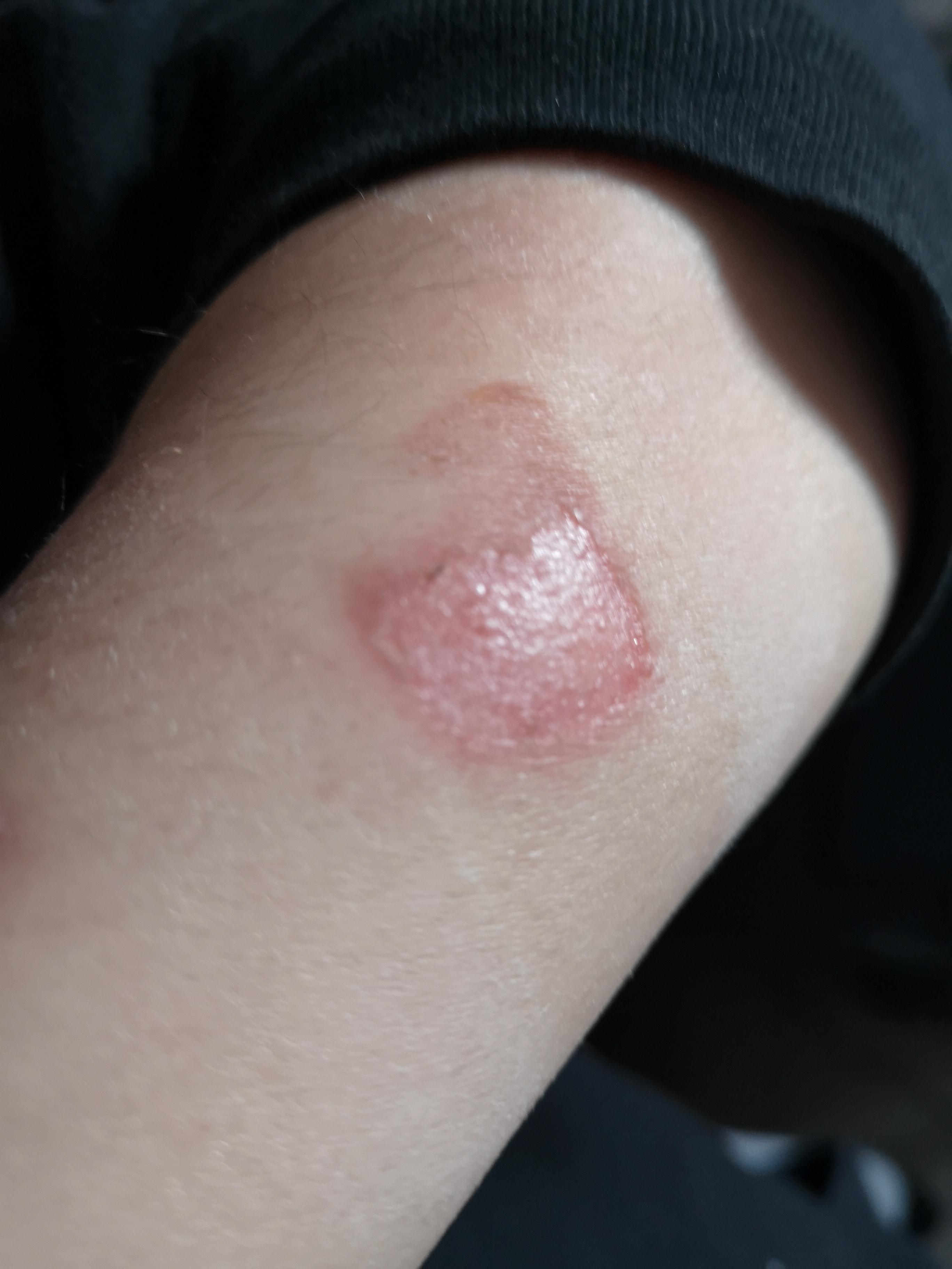 I need help with how to treat this burn wound (the blister "popped" 2