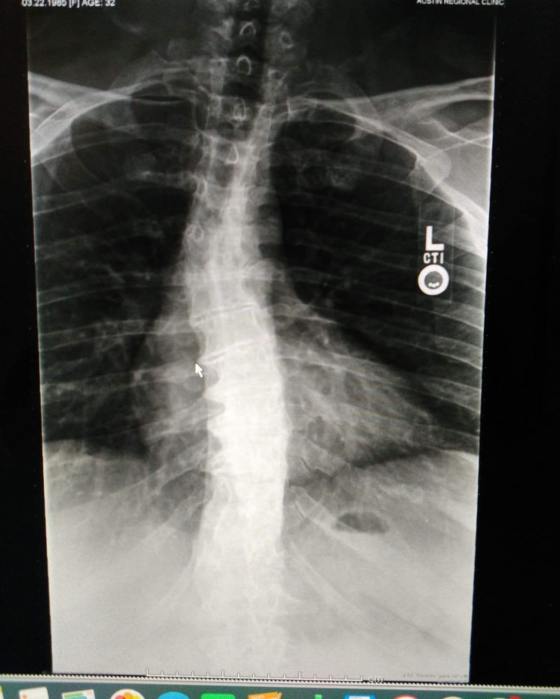 Degenerative disc disease and scoliosis, 34F. r/xrays