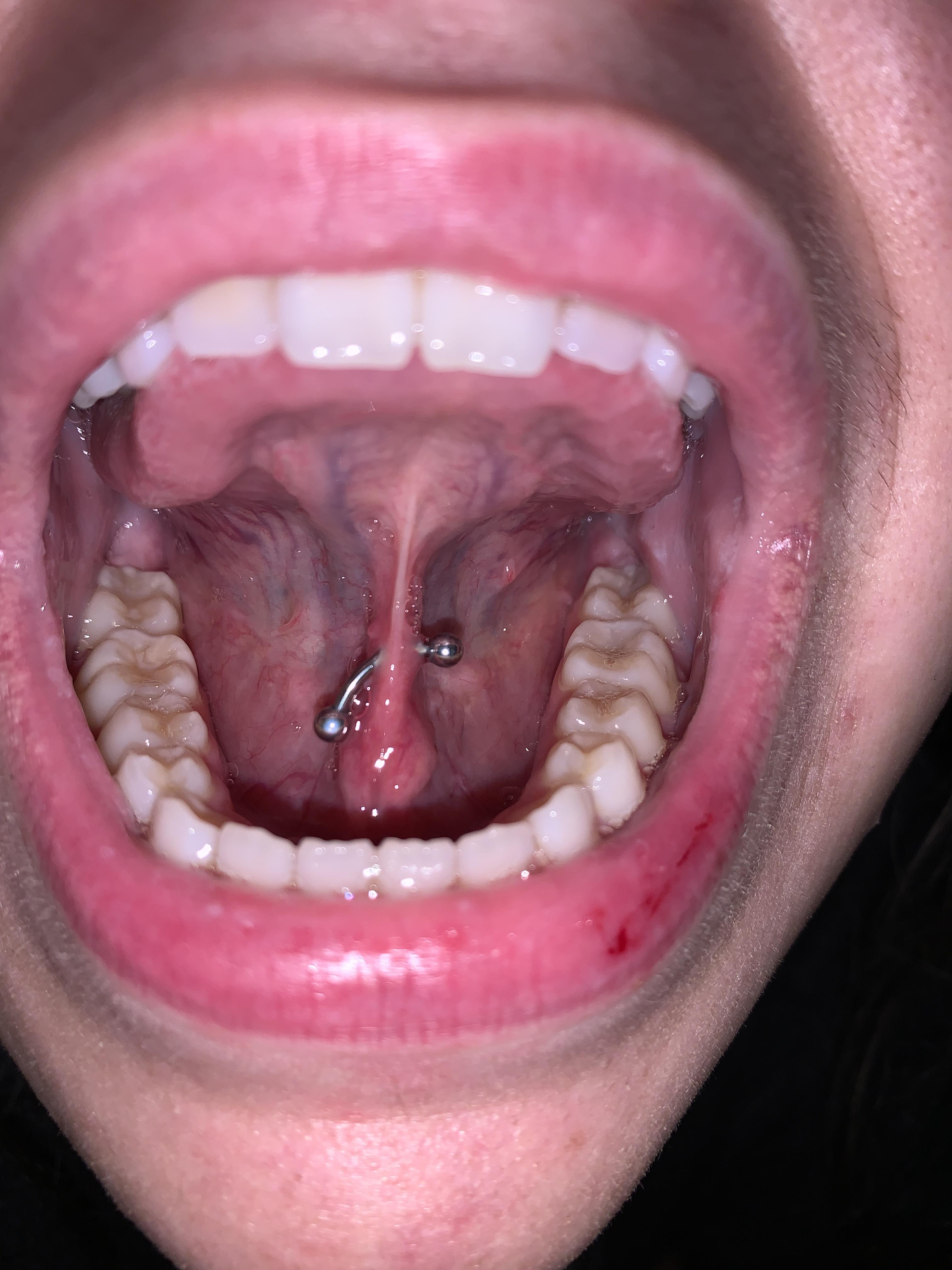 pls someone help ! Tongue web has been pierced for 2 days about and the