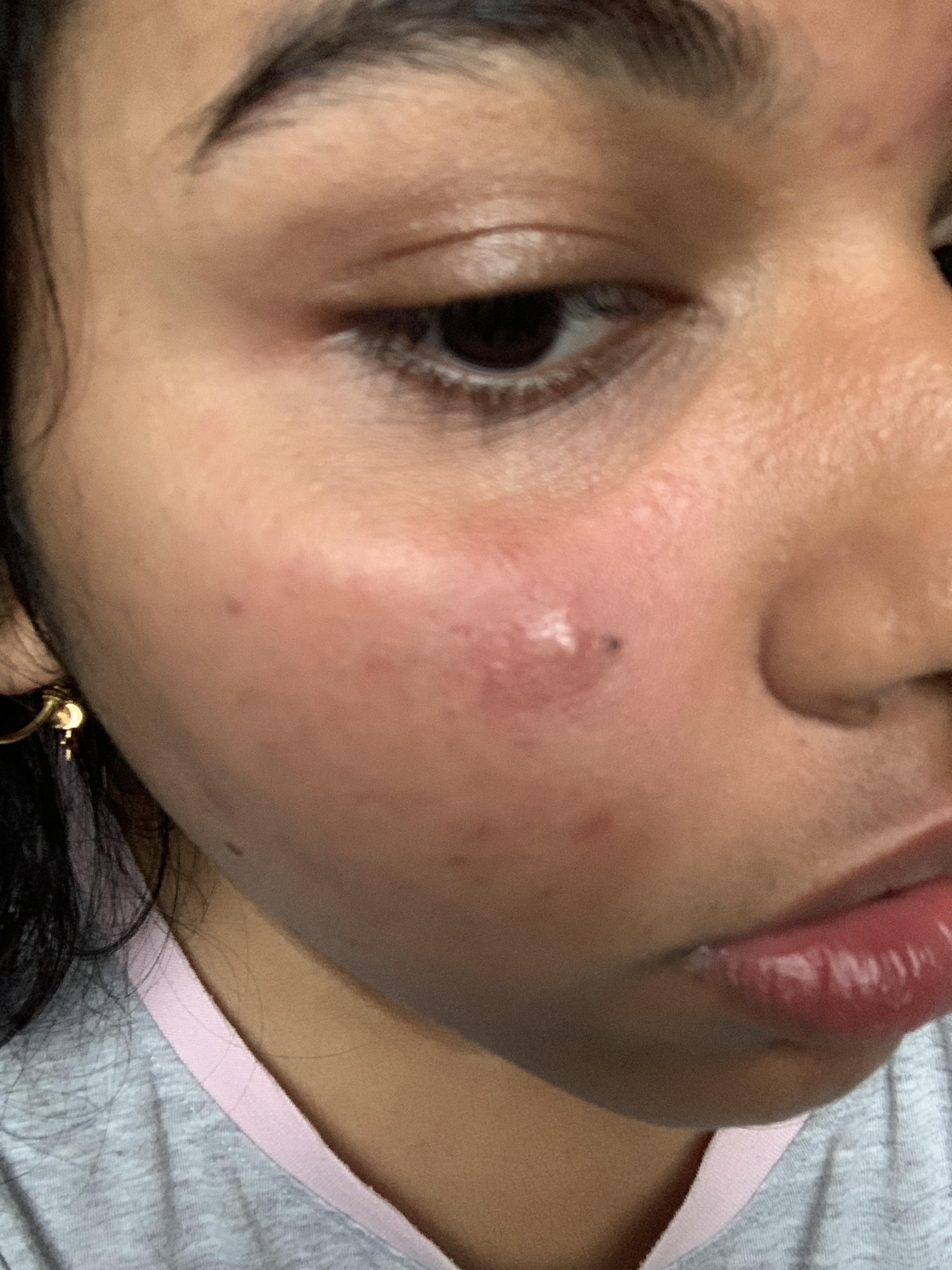 [acne] ok so idk if this a cyst or not. i’ve always felt a small bump