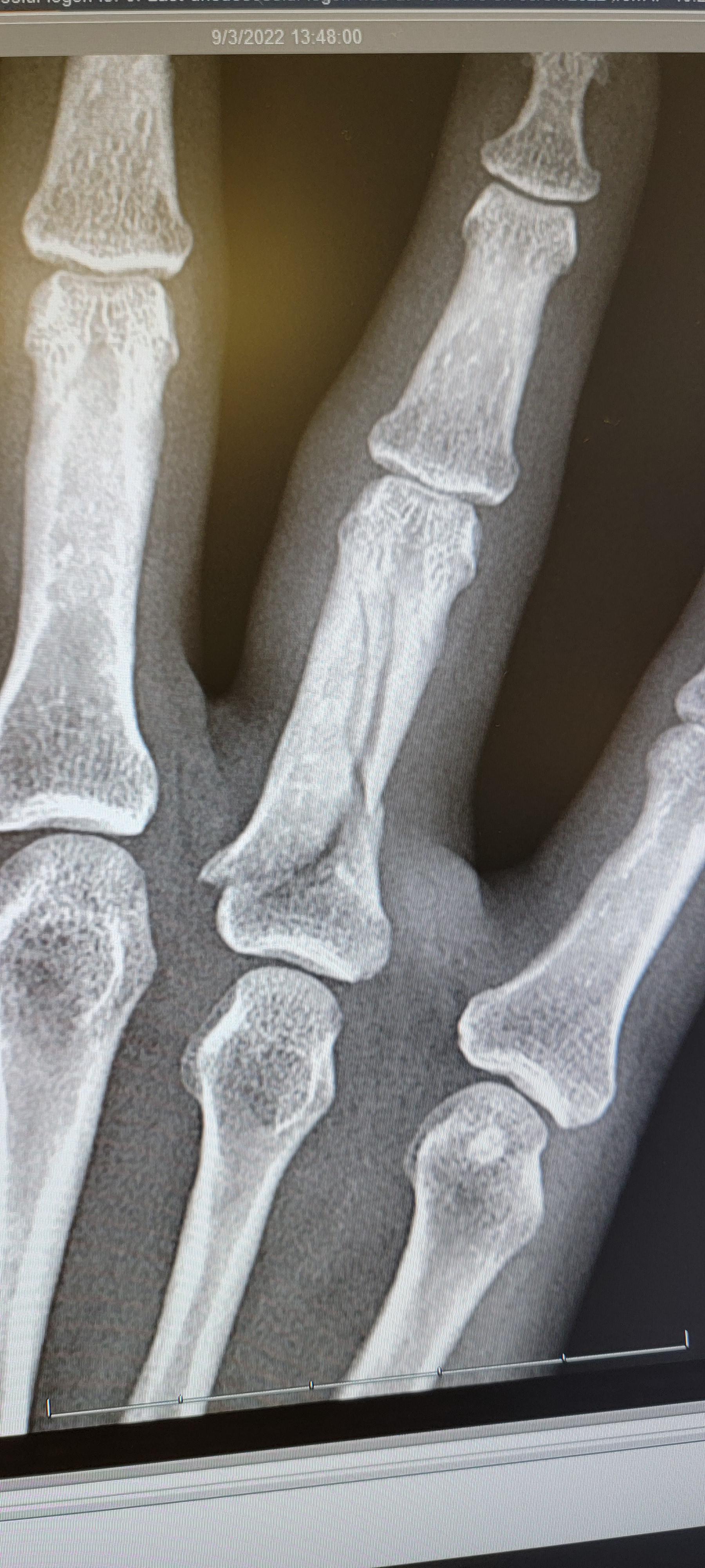 dog bite fractured finger r/ThatsInsane